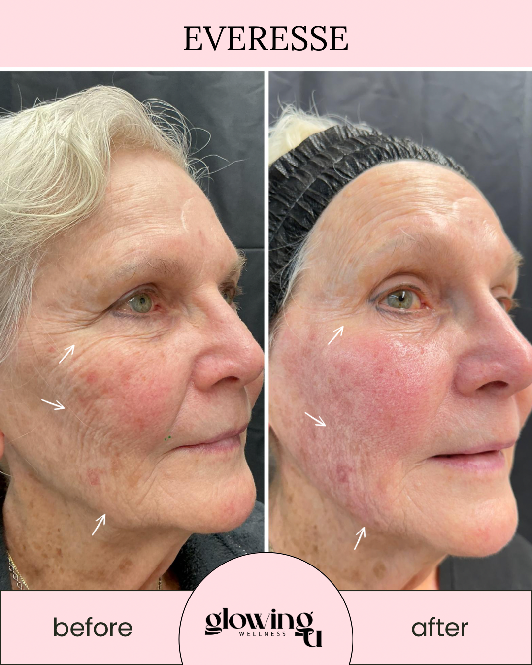Side-by-side comparison of a woman's face showing skin improvements. The before picture shows fine lines, wrinkles, and uneven skin tone. The after picture shows smoother skin with reduced wrinkles and a more even complexion. from Glowing U Wellness