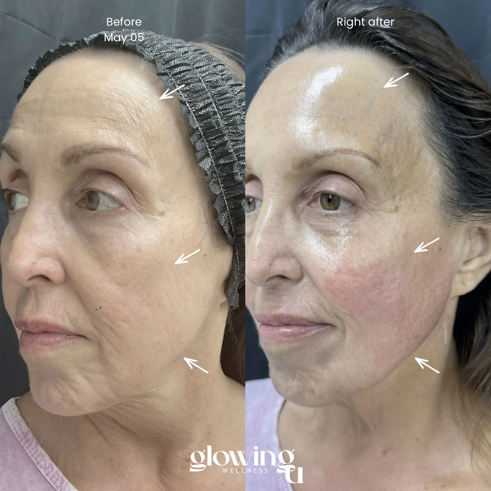 Complete Glow Protocol full face rejuvenation results at Glowing U Wellness Torrance CA