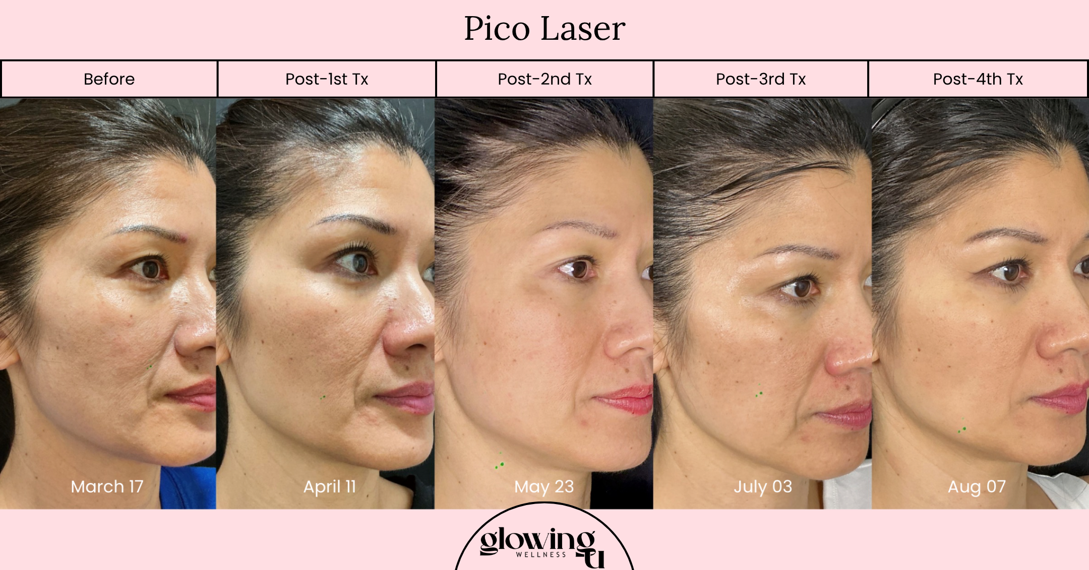 A side profile of a woman showing her skin before and after a series of laser treatments from March 17 to August 07. The photos demonstrate skin improvements over time, with visible reduction in blemishes and pigmentation.