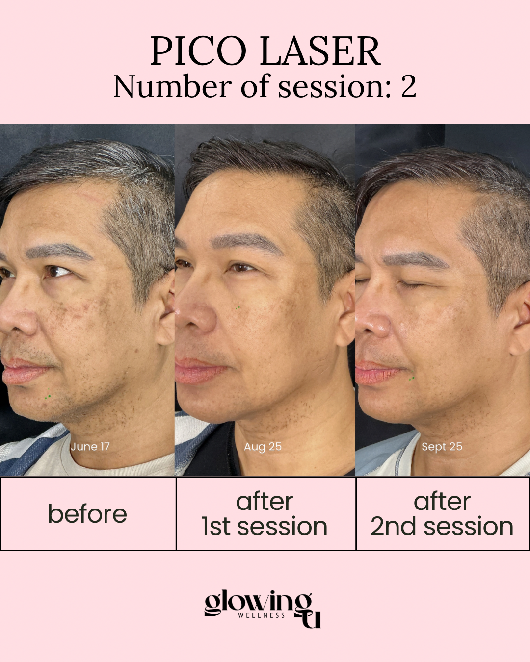 Progress photos of a man before and after Pico Laser treatments, showing improvements in skin appearance over three months, with dates June 17, August 25, and September 25.