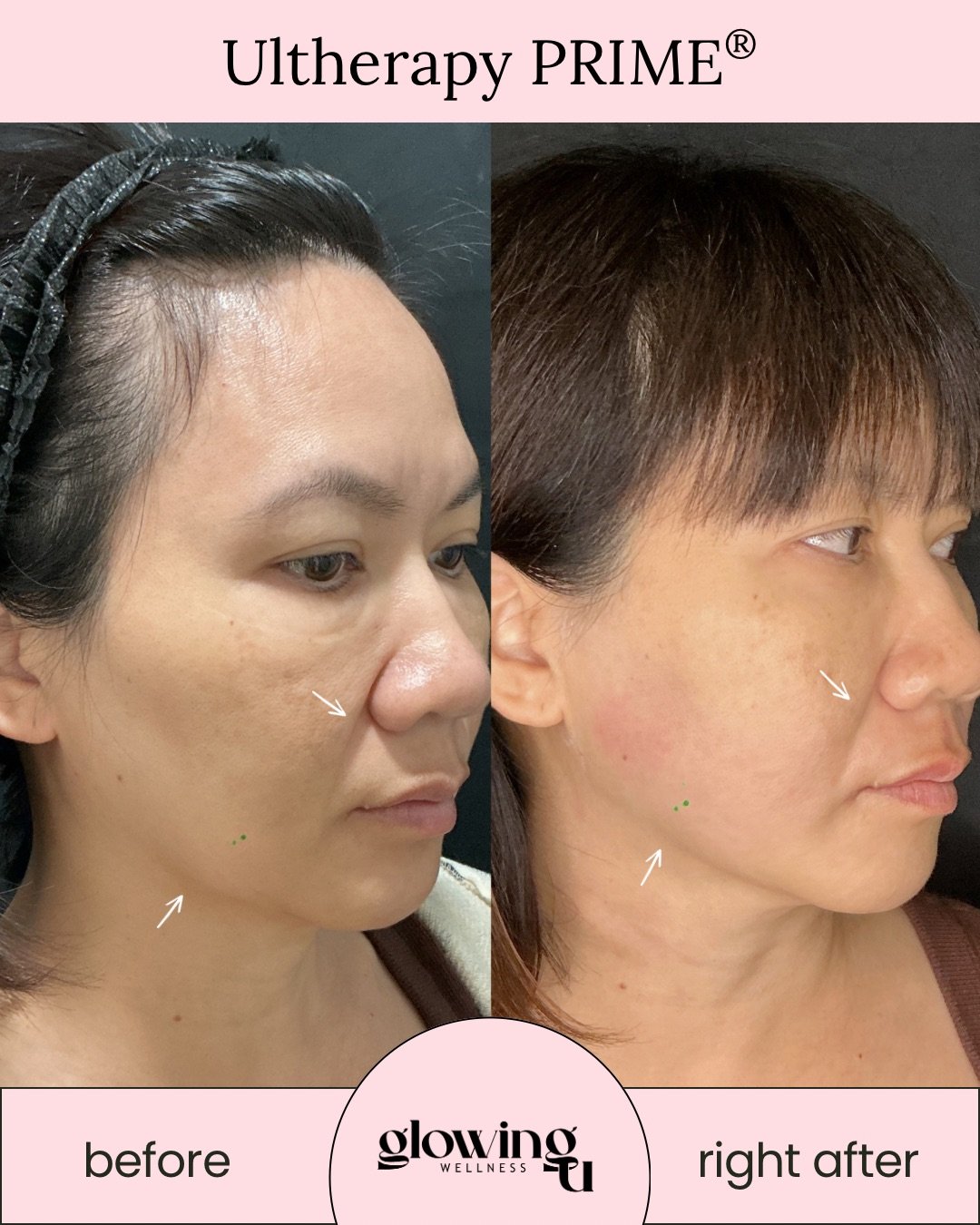 Side-by-side comparison of a woman's face before and after ultherapy treatment, showing improved skin firmness and texture.
