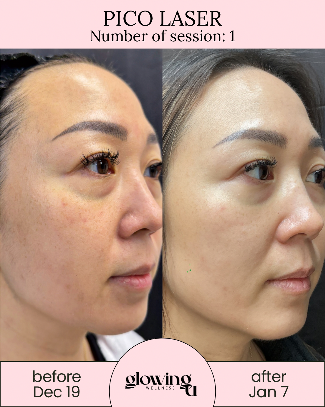 Side-by-side comparison of a woman's face showing clear improvement in skin texture and tone before and after a Pico Laser treatment. The left image is labeled 'before Dec 19' and the right 'after Jan 7'. The top banner reads 'PICO LASER' with 'Number of session: 1'. The bottom section features the logo 'glowing WELLNESS'.