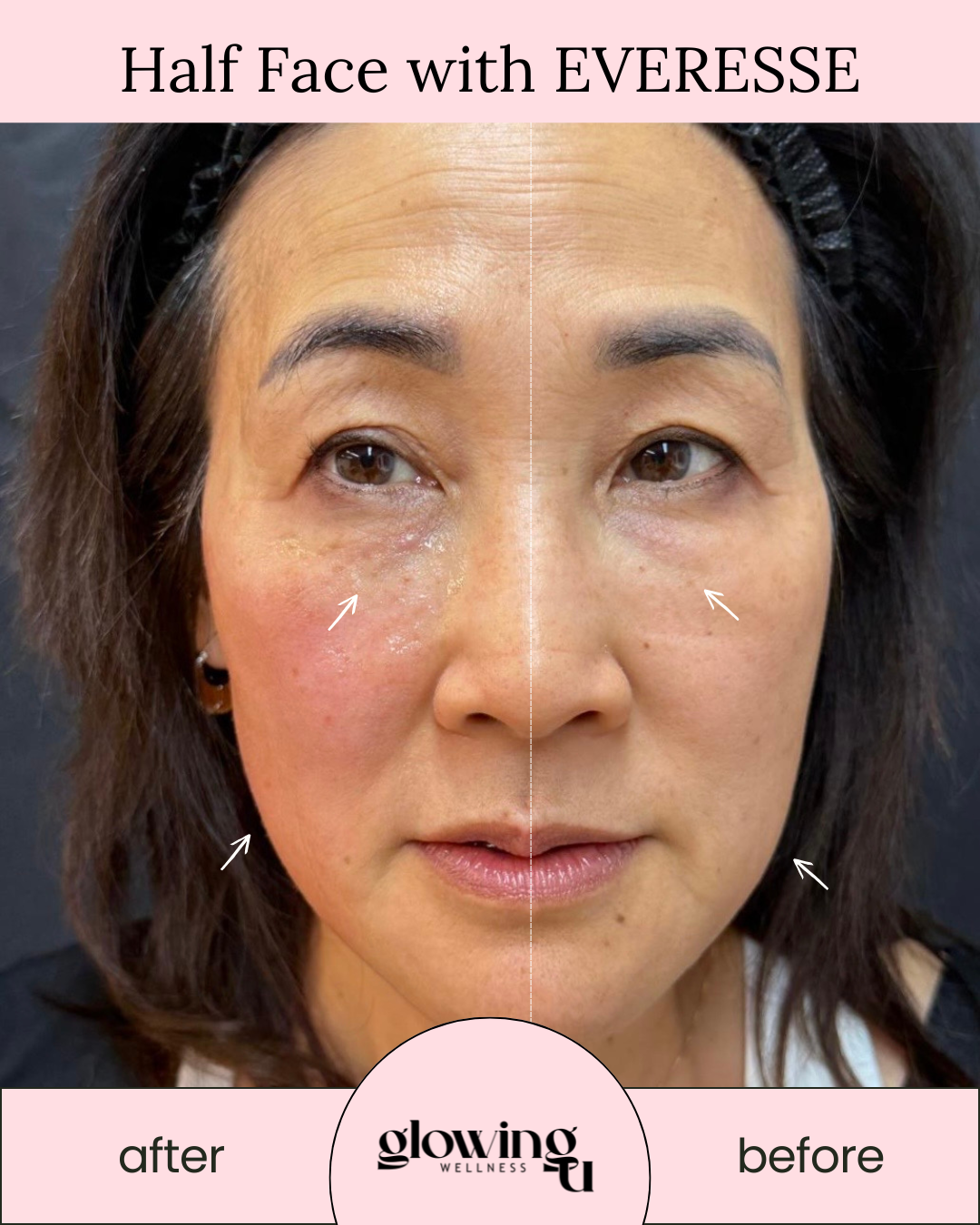 A side-by-side comparison of a woman's face showing the 'before' and 'after' effects of a treatment called 'Half Face with Everesse. from Glowing U Wellness