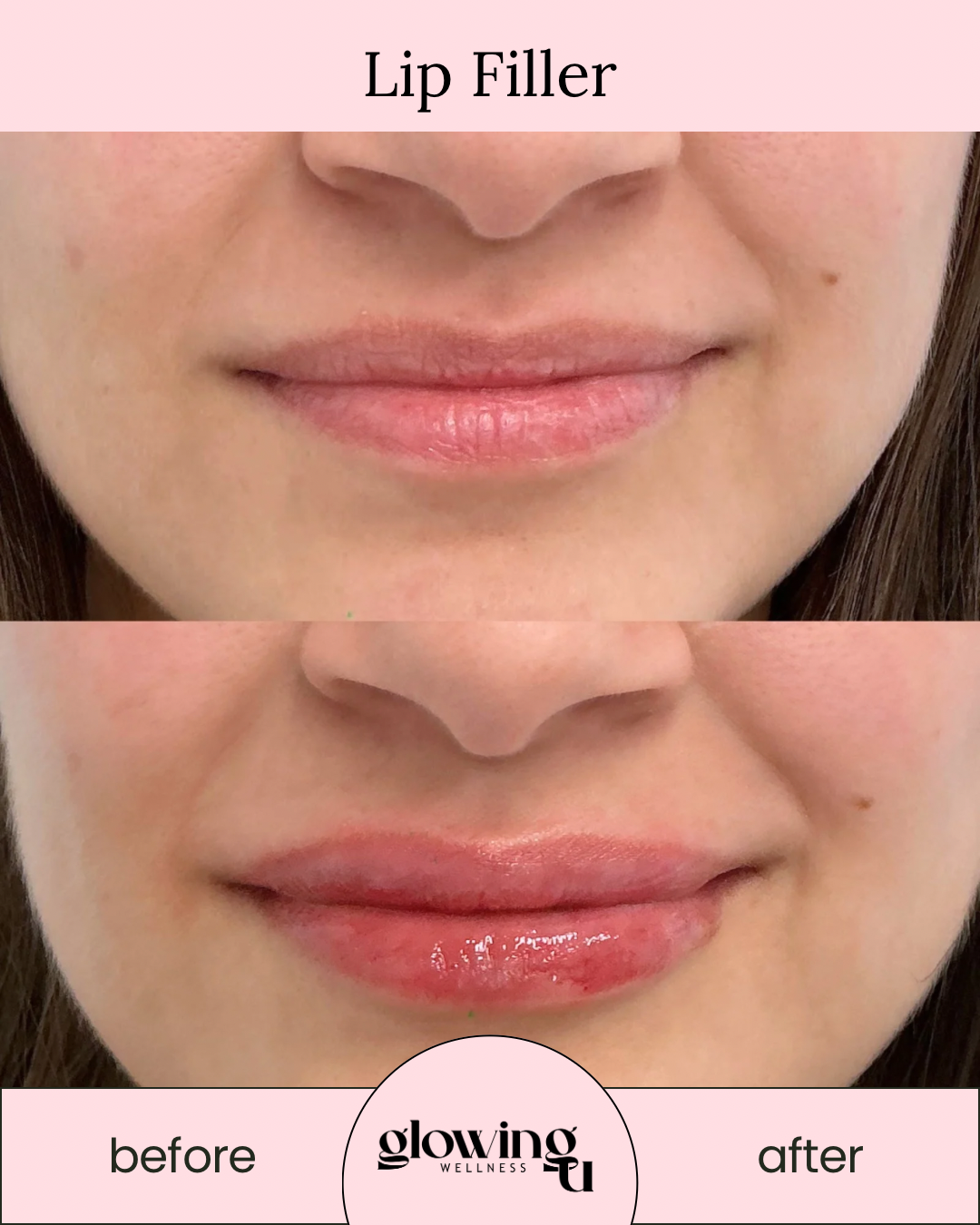 Comparison of lips before and after lip filler treatment, showing enhanced fullness and shine.