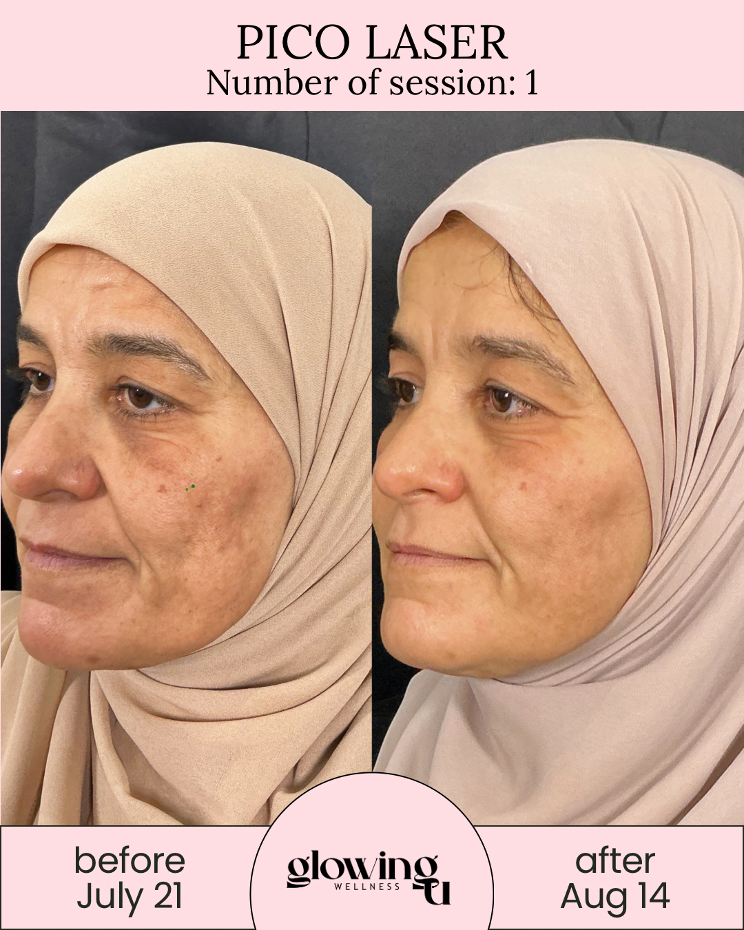 Side-by-side comparison of a woman's face before and after a Pico Laser treatment. The left image shows her skin with hyperpigmentation and uneven tone, while the right image shows clearer, more even skin. The treatment took place at Glowing Wellness, with session numbers 1. The 'before' photo was taken on July 21, and the 'after' photo on August 14.