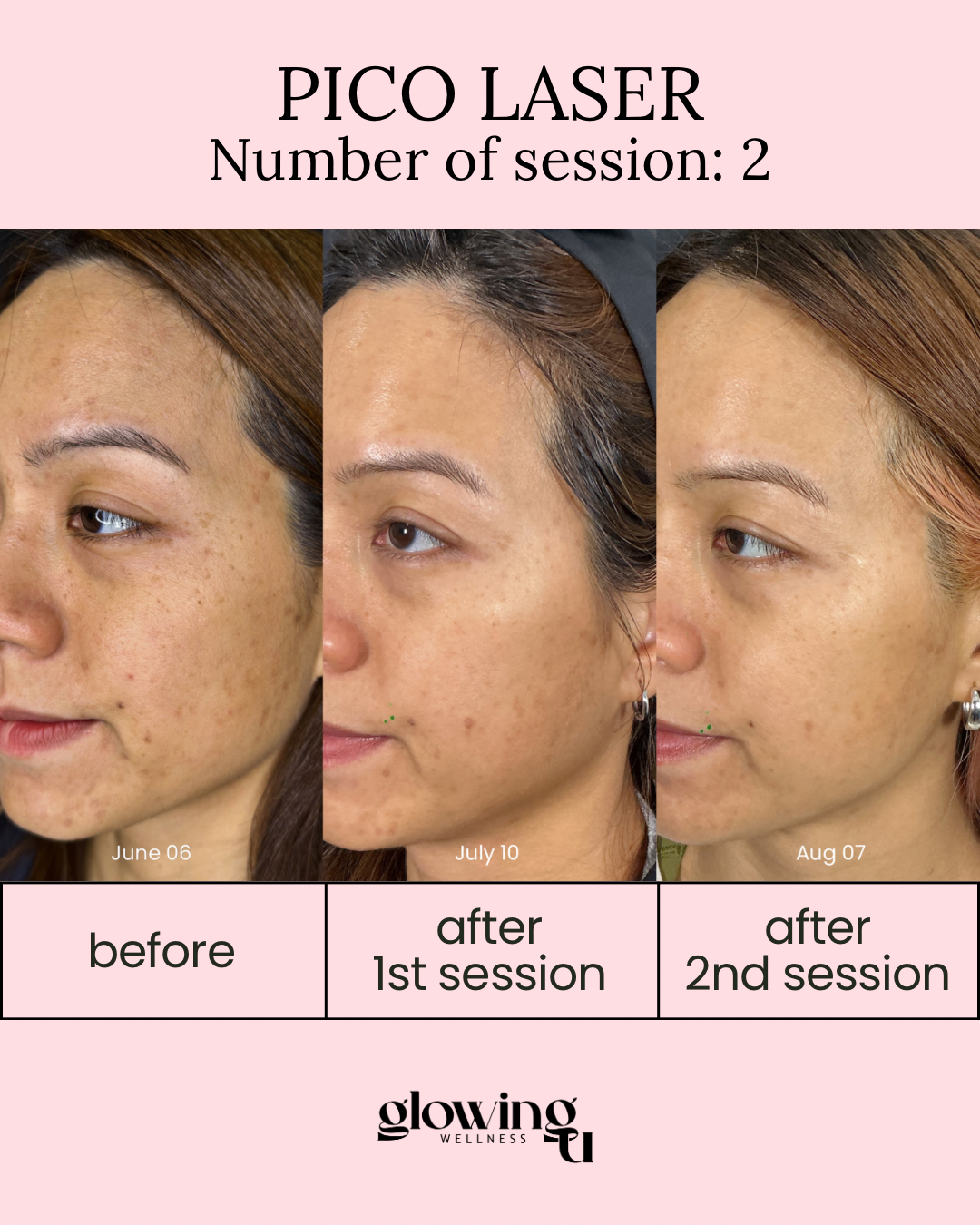 Comparison of a woman's face before and after Pico Laser treatments across three images, showing improvements in skin clarity and reduced pigmentation; dates are June 6, July 10, and August 7.