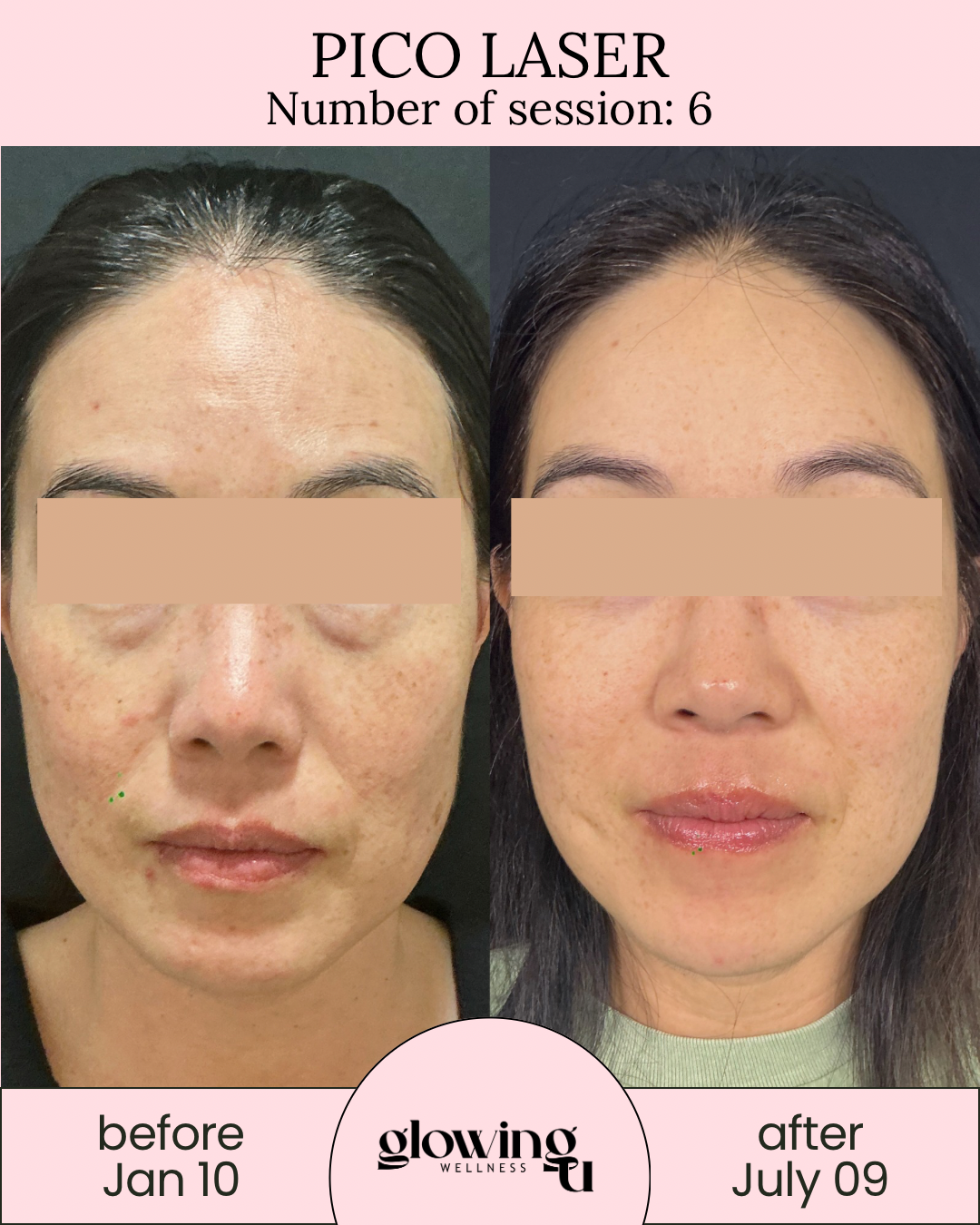 Side-by-side comparison of a woman’s face before and after a Pico Laser treatment, with the text indicating the treatment session number, dates, and wellness center name in a pink-themed layout.