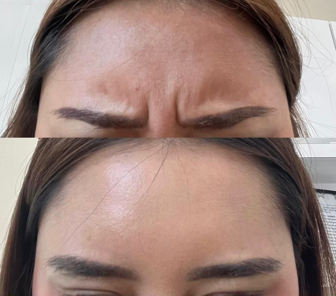 Close-up of a person's forehead showing a before and after comparison of skincare or makeup, highlighting smoother, clearer skin in the after image.
