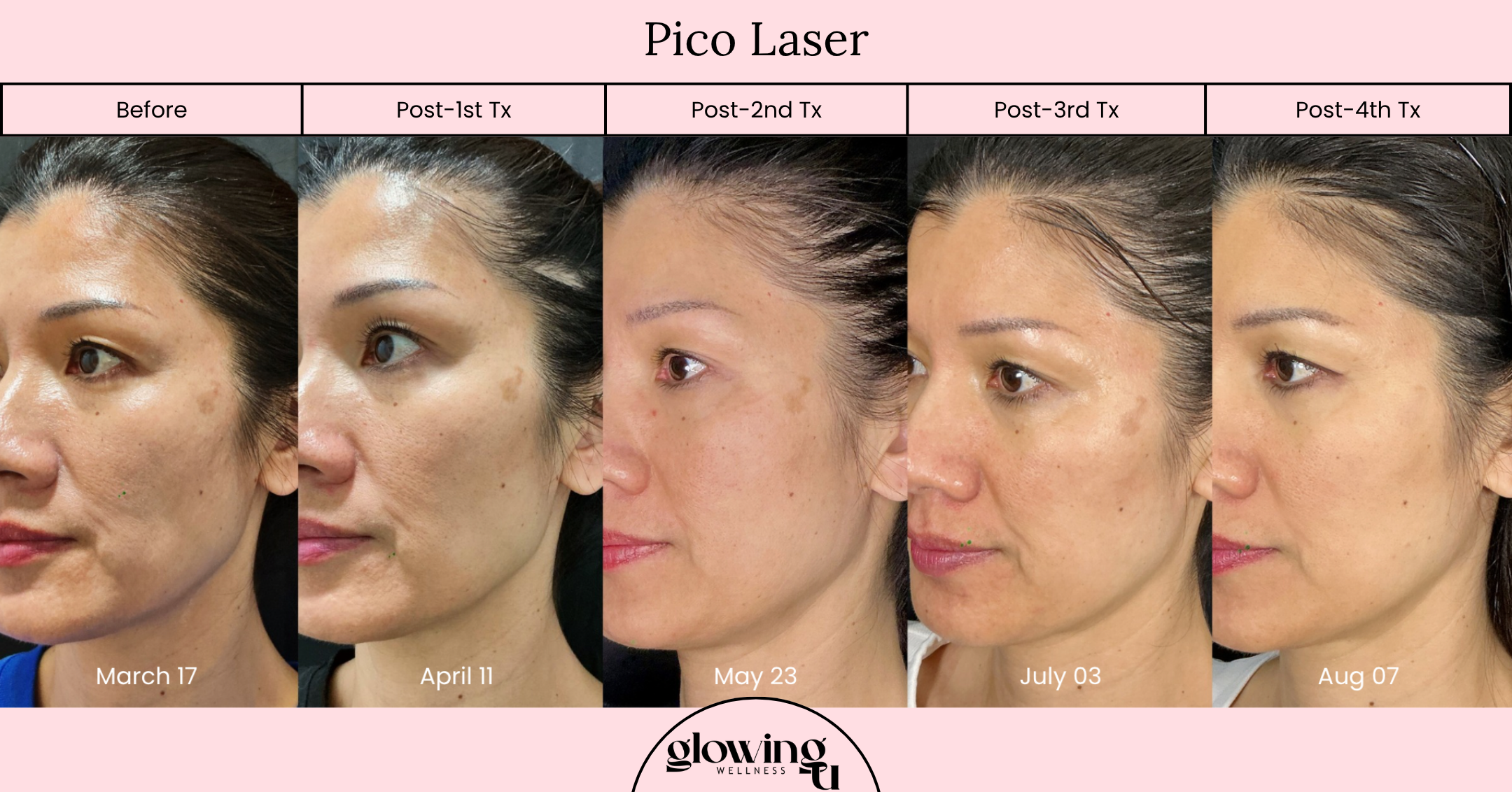 A series of five side-profile photos of a woman's face showing skin improvements over time, labeled with dates from March 17 to August 07, on a pink background with a pink header titled 'Pico Laser' and a circular logo at the bottom reading 'glowing wellness'.