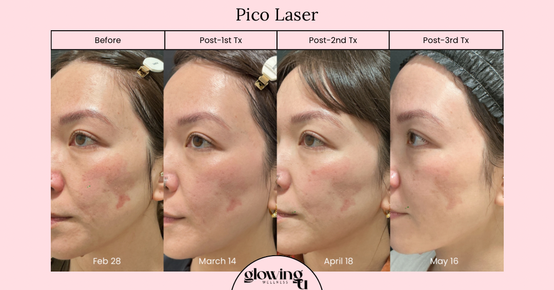 Progression of a woman's skin condition before and after pico laser treatments over several months, showing improvements in skin texture and pigmentation.