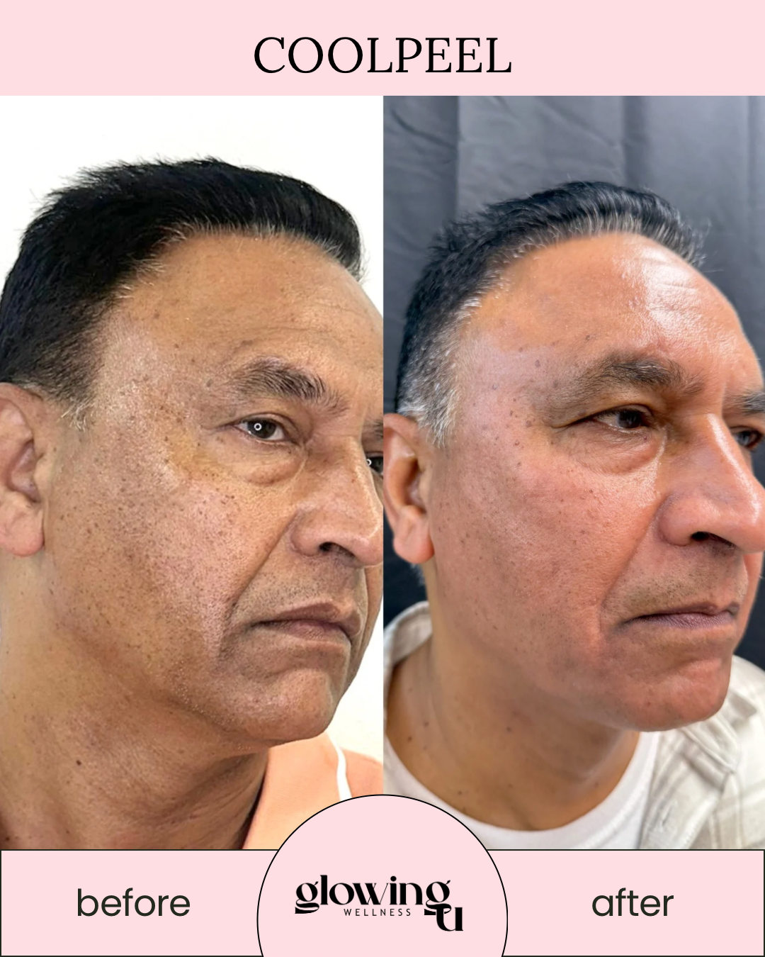 Side-by-side comparison of a man's face before and after skincare treatment, showing improved skin texture and appearance, with text "COOLPEEL" at the top and