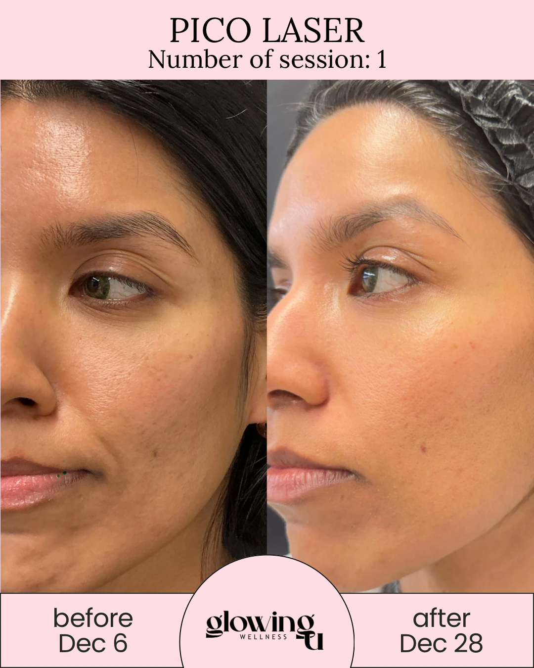 Side-by-side comparison of a woman's face showing skin improvements from Pico Laser treatment. The left shows her skin on December 6 with visible blemishes and uneven texture, while the right shows her skin on December 28 with clearer, smoother skin. The image is branded with Glowing Wellness.