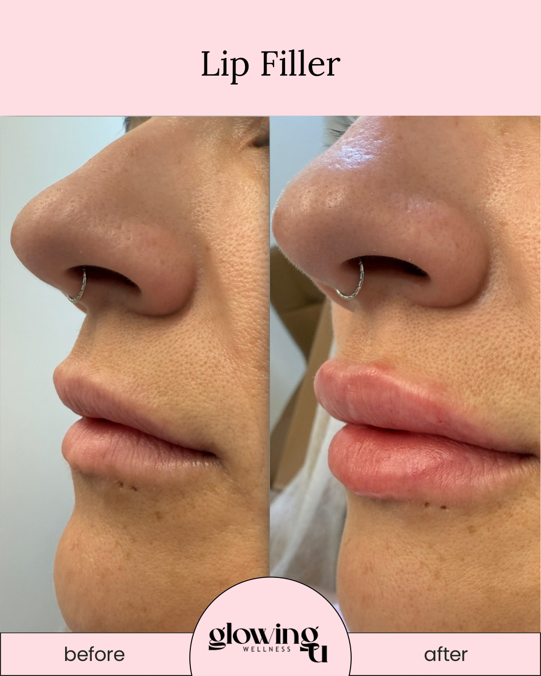 Before and after photos showing the results of lip filler treatment, with the after photo displaying fuller lips.