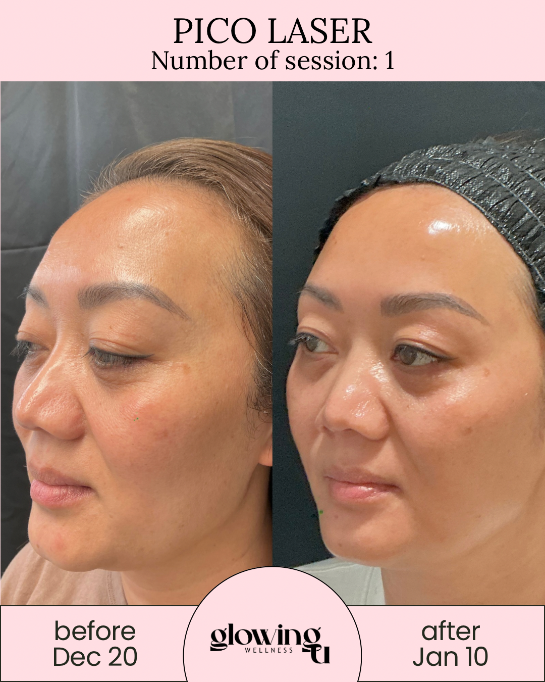Comparison of a woman's face before and after laser treatment, showing improvements in skin texture and brightness at Glowing Wellness, with dates December 20 and January 10.
