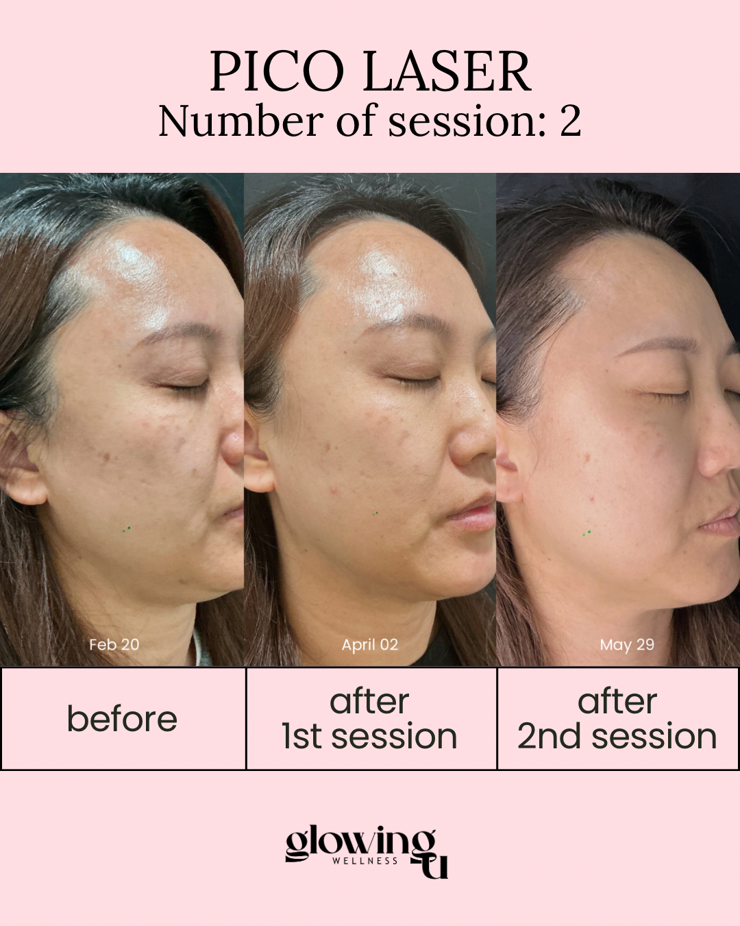 Progress photos showing a woman's face before, after first Pico Laser session, and after second session, with visible improvement in skin clarity and texture.
