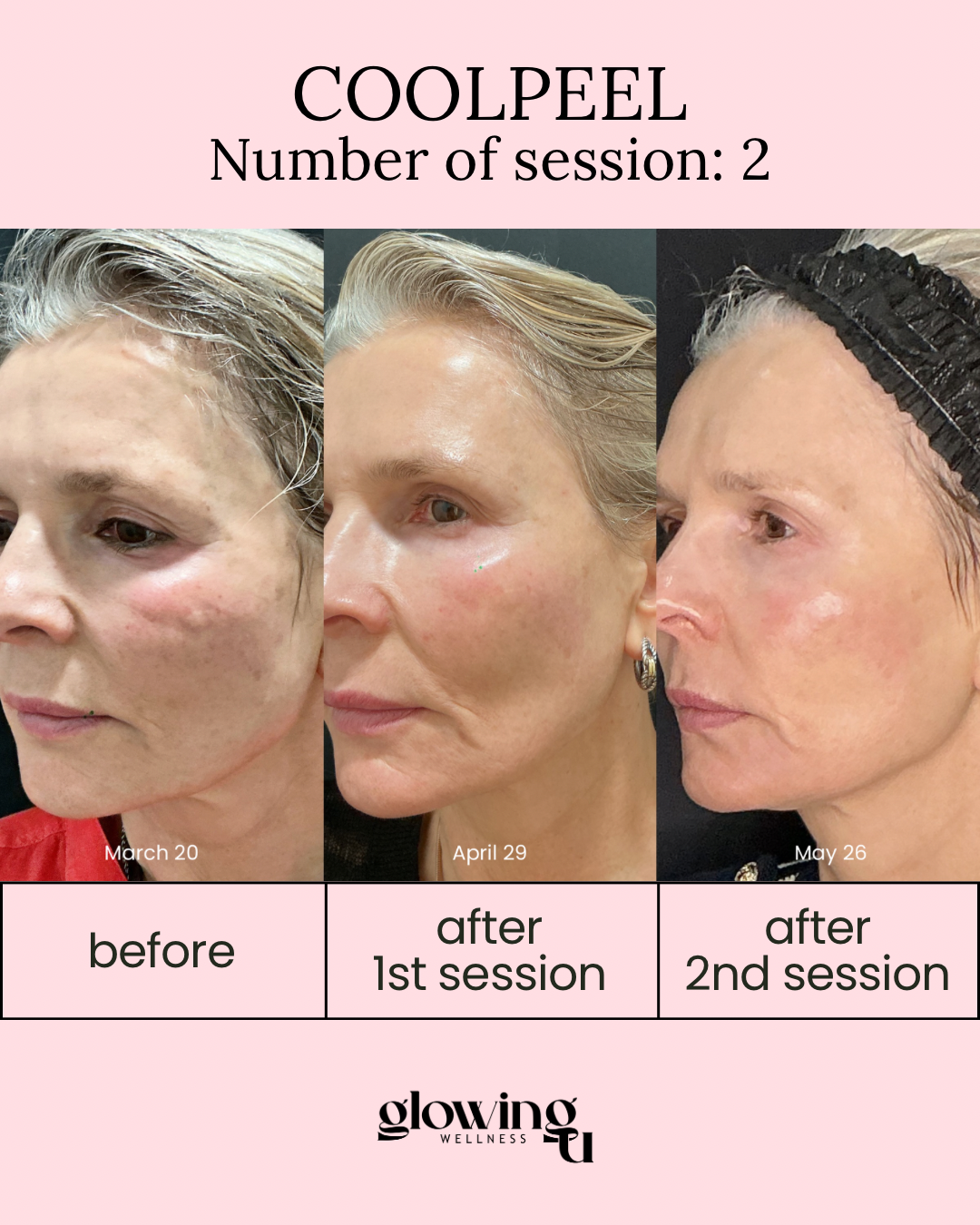 CoolPeel CO2 laser skin resurfacing results at Glowing U Wellness Torrance CA