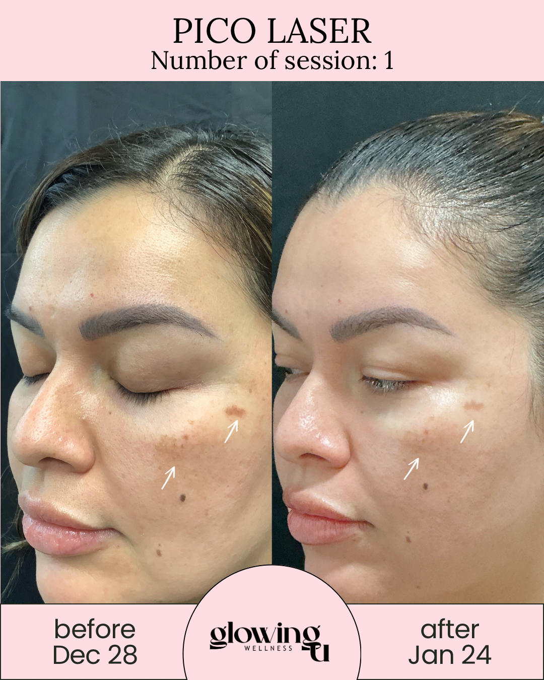 Before and after photos of a woman's face showing improvement in skin clarity and reduction of dark spots following Pico Laser treatment, with dates December 28 and January 24 respectively.