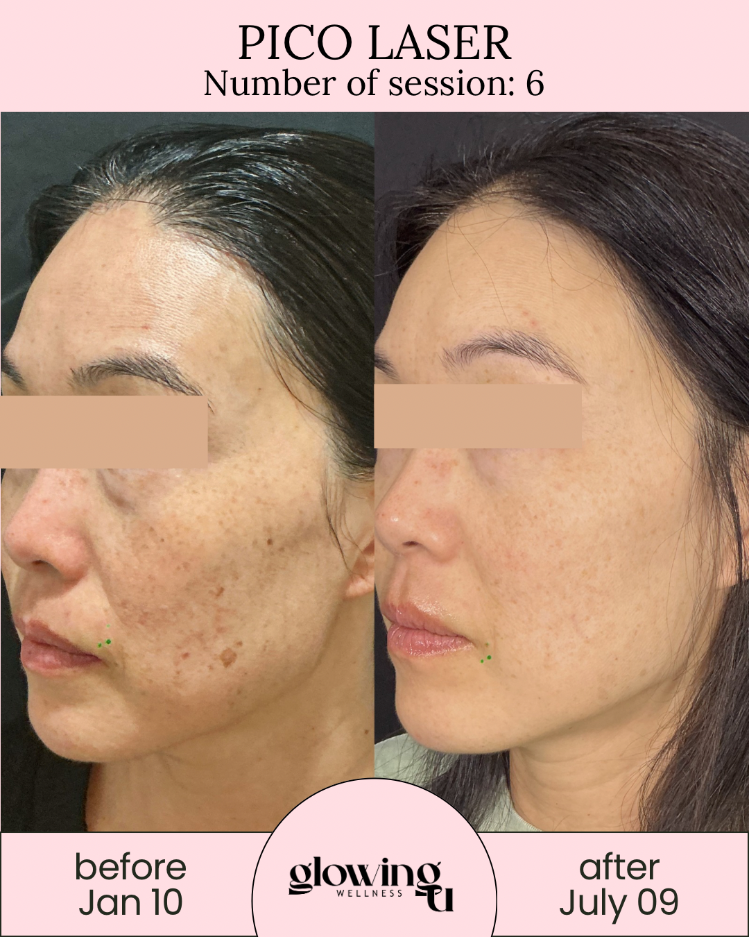 Side-by-side comparison of a woman's face before and after Pico Laser treatment. The left side shows her face on January 10, with visible dark spots and hyperpigmentation. The right side shows her face on July 9, with a more even skin tone and reduced pigmentation. The top text indicates Pico Laser treatment with her session number 6. The bottom text mentions the wellness center, Glowing Wellness, where the treatment was administered.