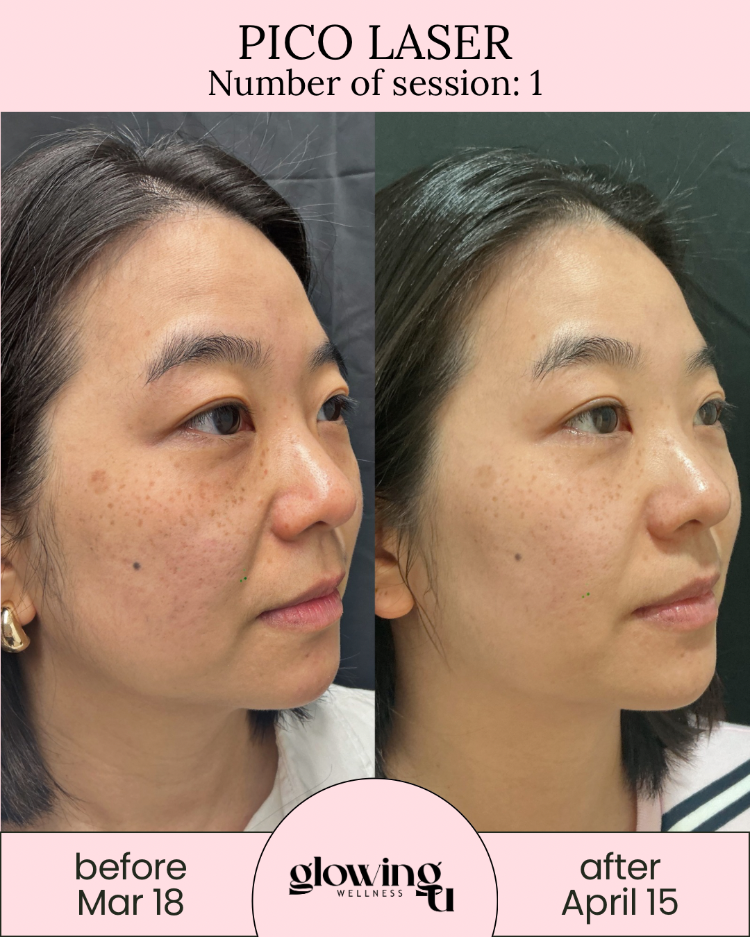 Side-by-side comparison of a woman's face showing skin improvement before and after laser treatment. The left image is labeled 'before Mar 18' with darker freckles and uneven skin tone, and the right image is labeled 'after April 15' with clearer skin.