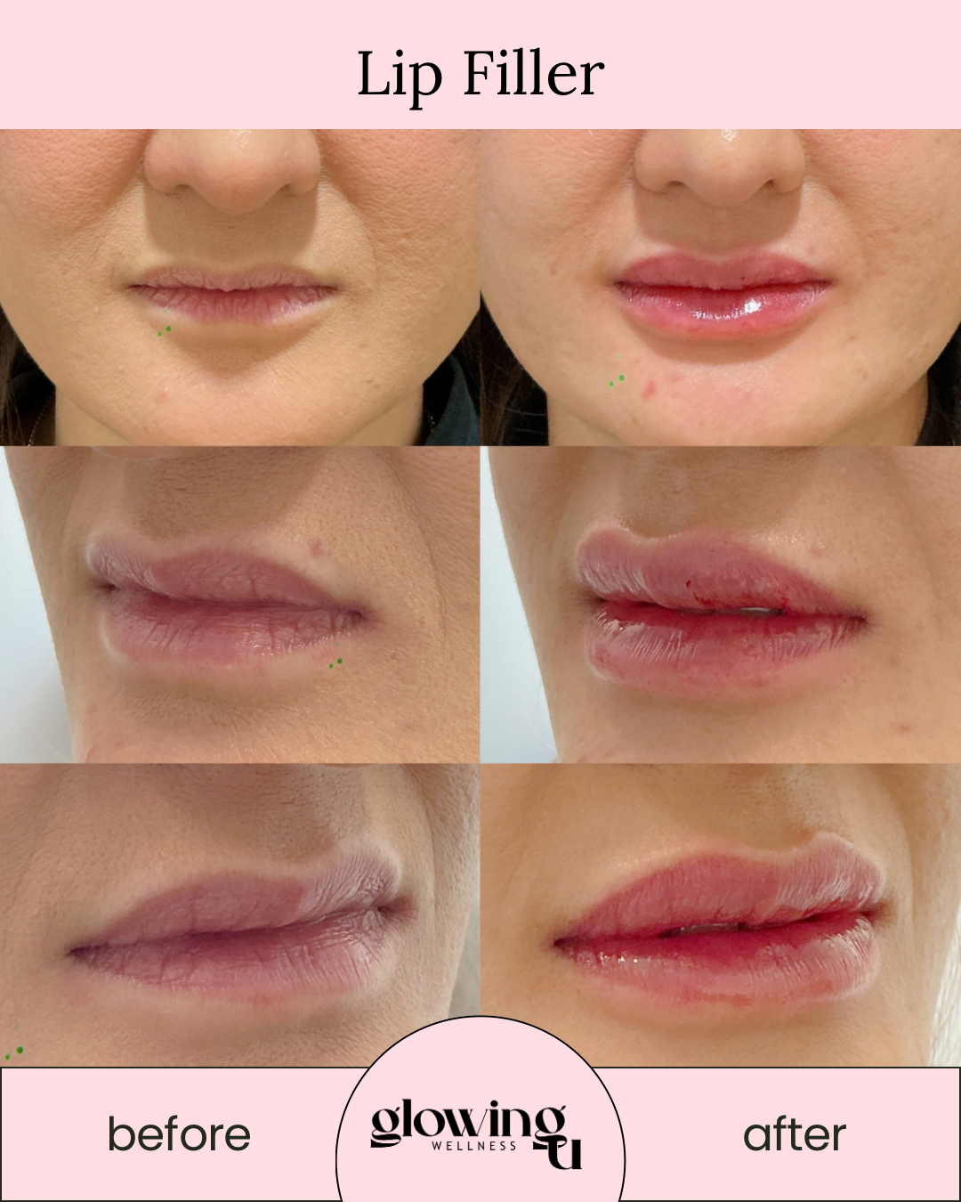 Side-by-side comparison of lips before and after lip filler treatment, showing increased fullness and glossiness.