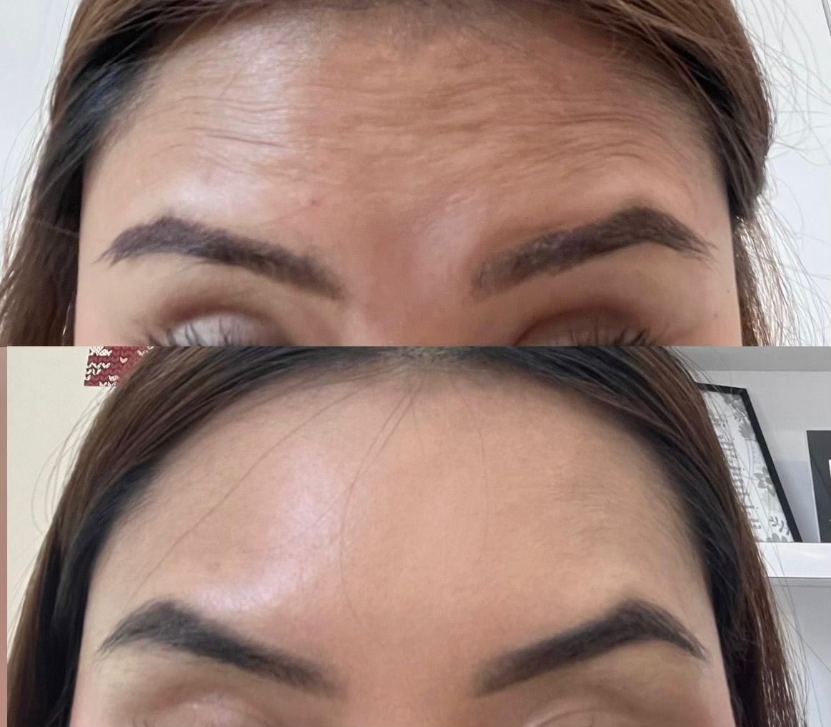 Close-up comparison of a person's forehead and eyebrows before and after skincare or treatment, showing smoother skin and well-defined eyebrows.