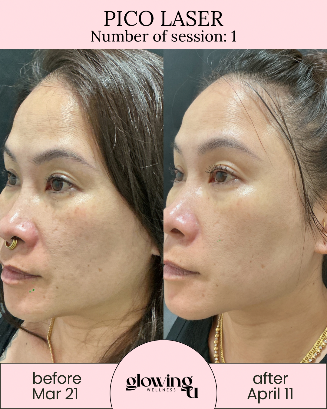 Side-by-side comparison of a woman's face before and after a Pico Laser treatment, showing improvement in skin texture and pigmentation. The left side is labeled "before Mar 21", and the right side is labeled "after April 11."