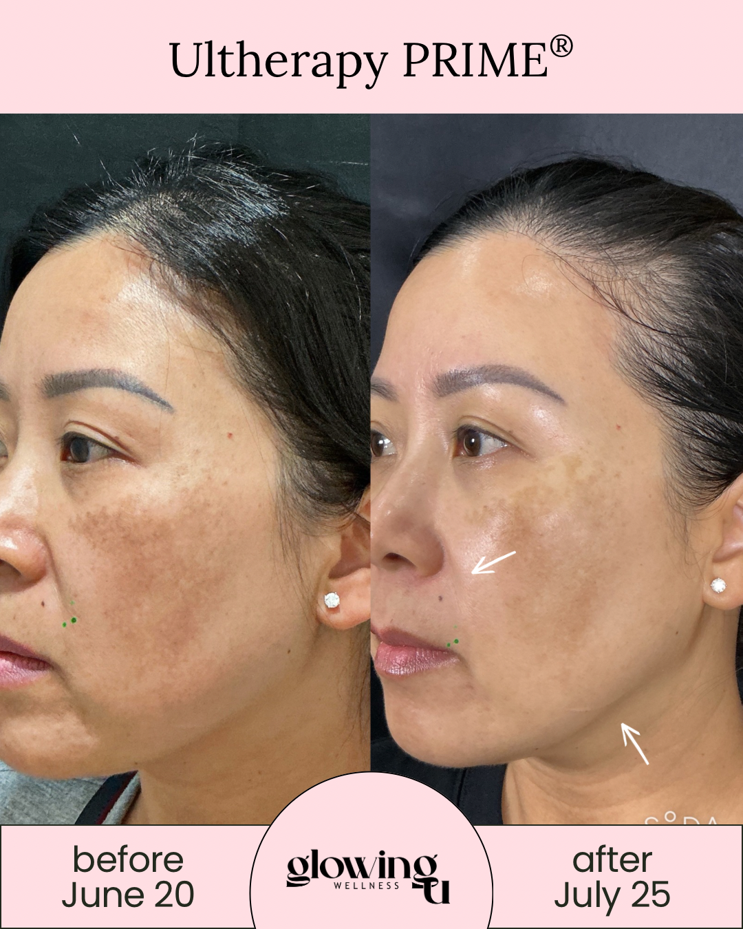 Side-by-side comparison of a woman's face showing improvements in skin pigmentation and texture after Ultherapy PRIME treatment, with dates June 20 and July 25.