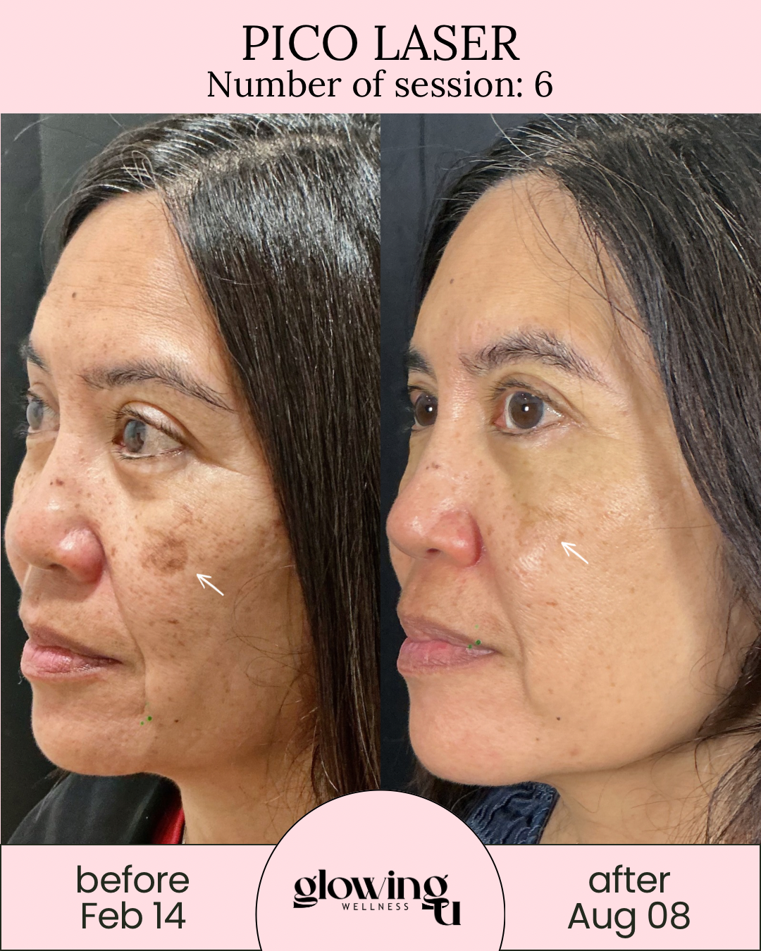 Side-by-side comparison of a woman's face showing improvement in skin pigmentation and texture after Pico Laser treatment, with before photo dated February 14 and after photo dated August 8.