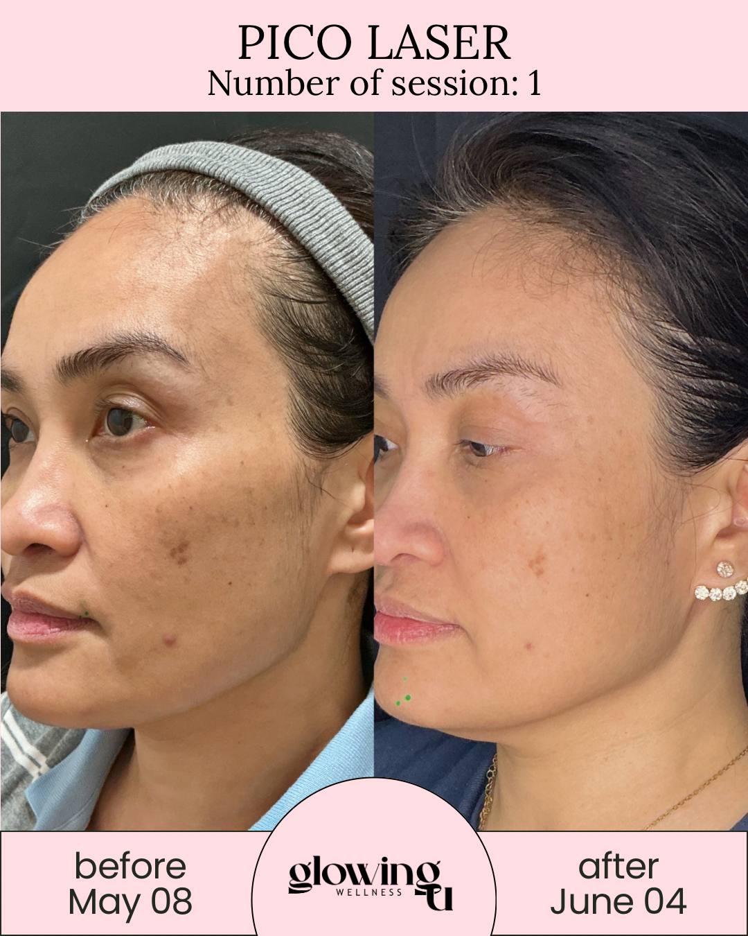 Side-by-side comparison of a woman before and after a skin treatment, showing clearer skin on the right. The top of the image has text indicating it is for Pico Laser with session number 1. The left side displays her face as it was before the treatment on May 8, and the right side shows her face after the treatment on June 4. The bottom features the Wellness logo, with a "before" label on the left and an "after" label on the right.