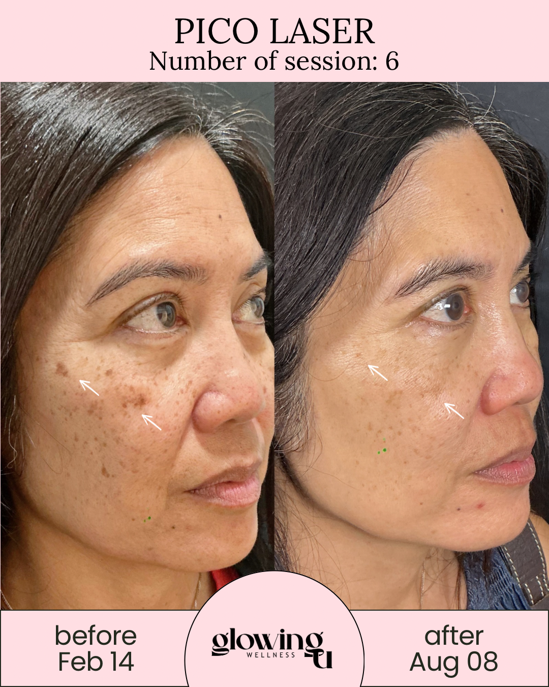 Side-by-side comparison of a woman's face showing skin improvements from Pico Laser treatment; before photo from February 14 and after photo from August 8; closely cropped face with clear skin and some freckles.