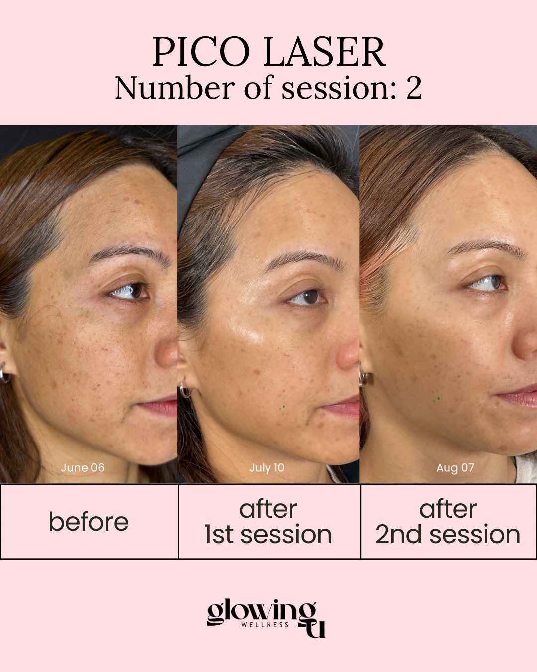 Progress photos of a woman's face showing skin improvement over time after Pico Laser treatments. The images are labeled with dates June 06, July 10, and August 07, and categorized as before, after 1st session, and after 2nd session, respectively.