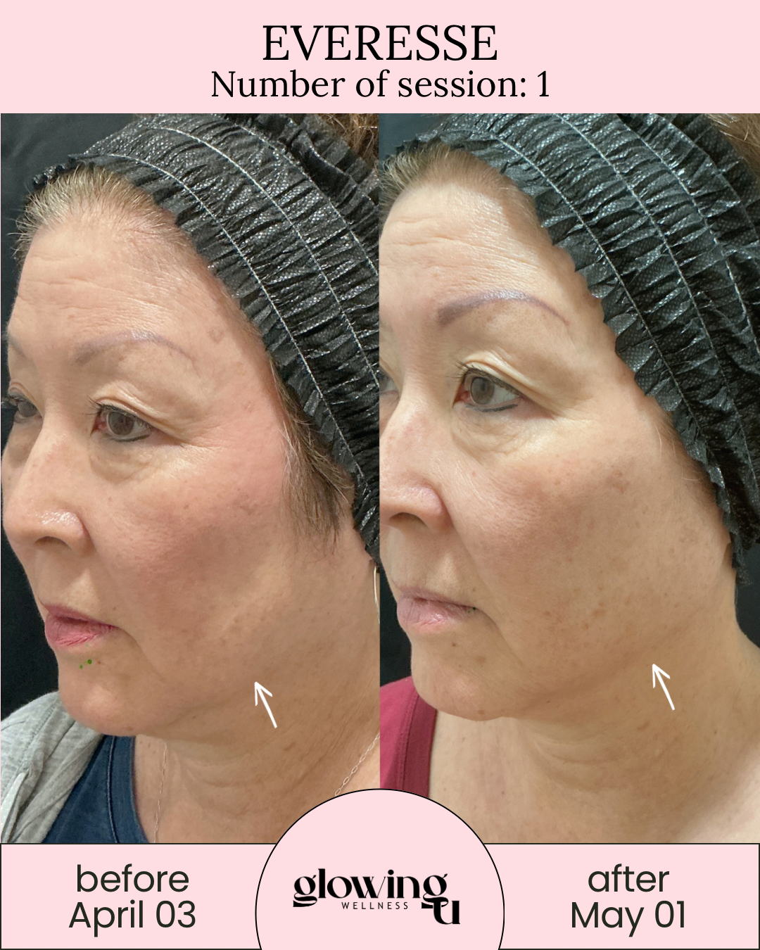 Side-by-side comparison of a woman's face before and after skincare treatment. The left shows her skin with visible uneven texture, fine lines, and pigmentation. The right shows improved skin with smoother texture, reduced lines, and more even tone. The woman is wearing a black headband and a red top in the after photo.