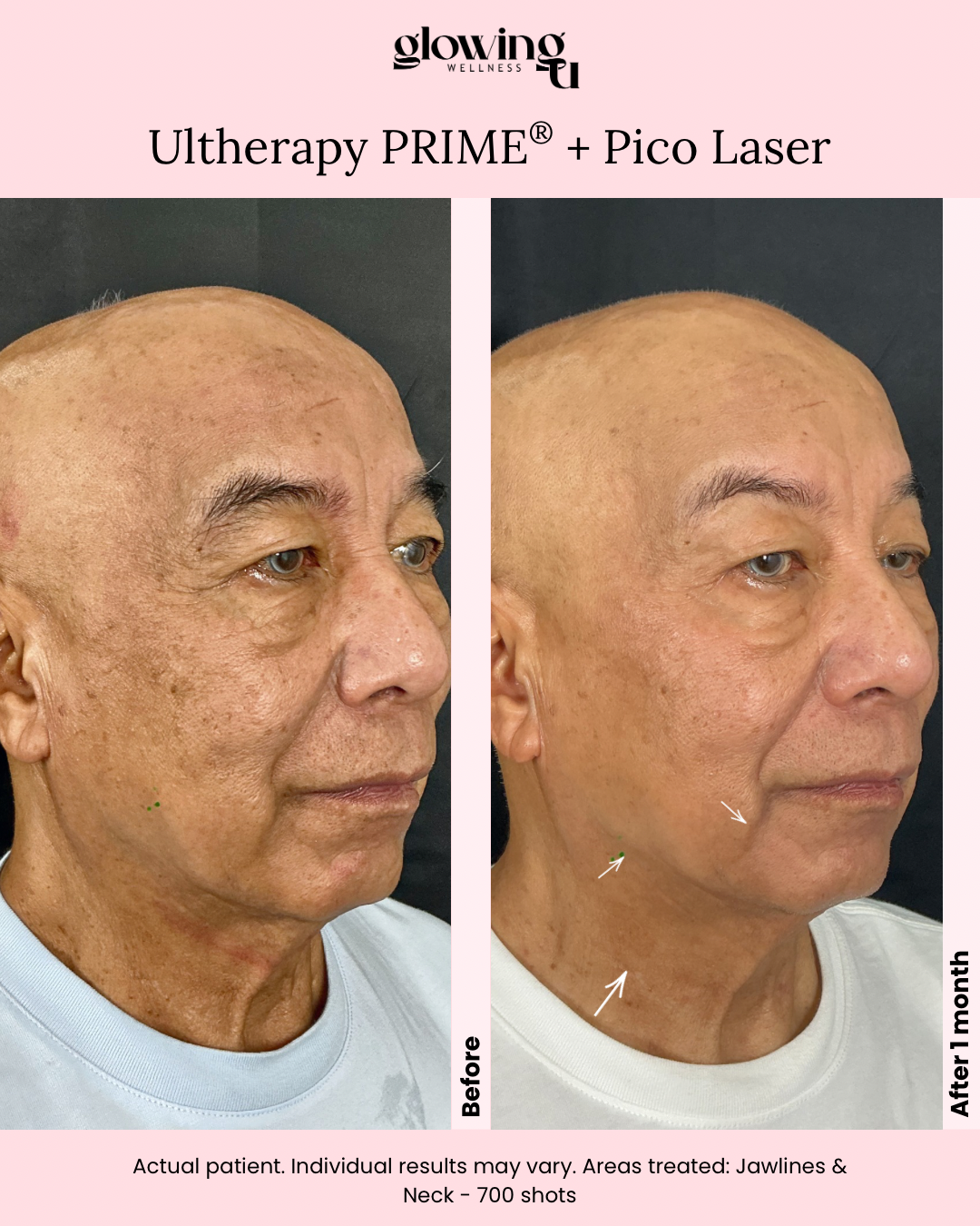 Side-by-side before and after photos of a man showing skin improvements after Ultherapy PRIME and Pico Laser treatment, with visible reduction in wrinkles and skin tightening on jawline and neck.