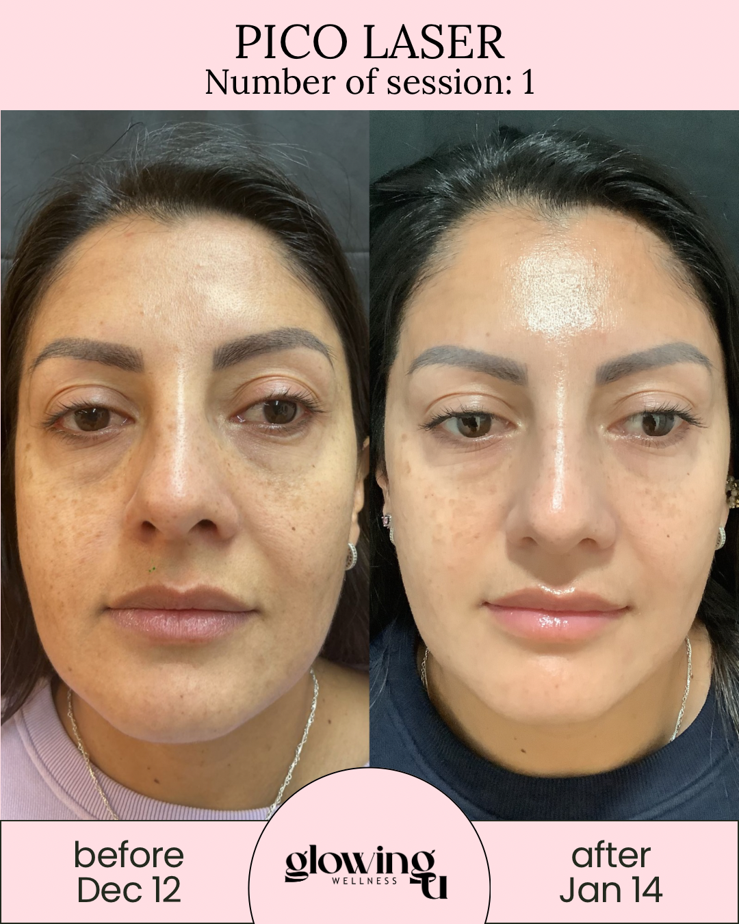 Side-by-side comparison of a woman's face before and after a laser treatment, showing improvements in skin texture, pigmentation, and overall complexion, with the treatment session number and dates noted, and a healing glow on the skin in the after image.
