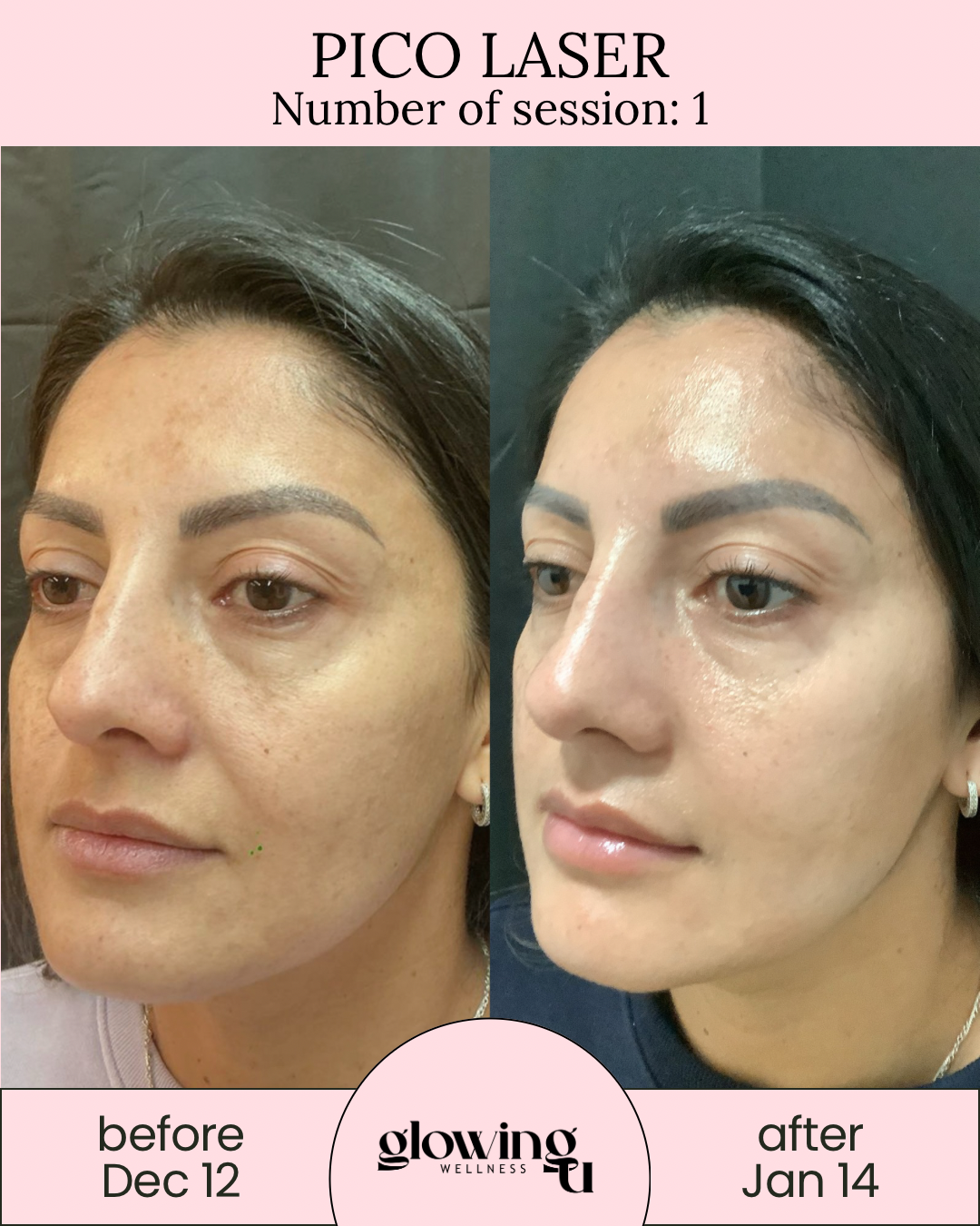 Side-by-side comparison of a woman's face showing improvements in skin texture and clarity after Pico Laser treatment. Before photo taken on December 12, and after photo taken on January 14, with text indicating one session of Pico Laser at Glowing Wellness.