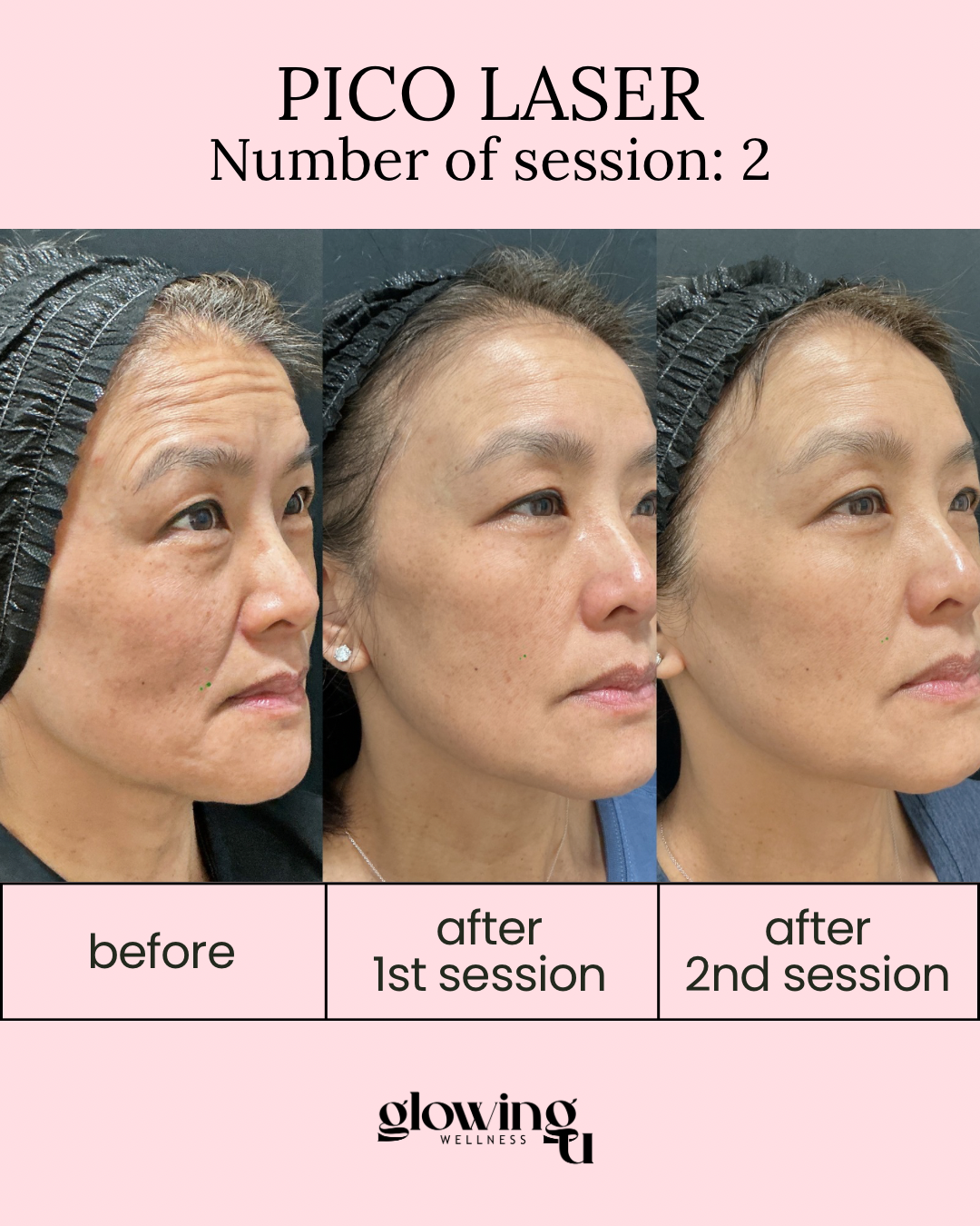 Comparison of a woman's face before, after first Pico Laser session, and after second session, showing skin improvements.