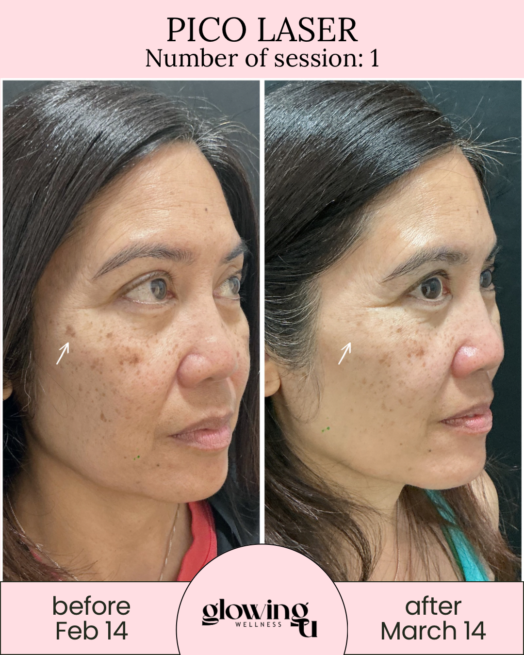 Side-by-side comparison of a woman's face showing skin improvement, labeled 'before Feb 14' and 'after March 14,' with text indicating a Pico Laser session at Glowing Wellness.