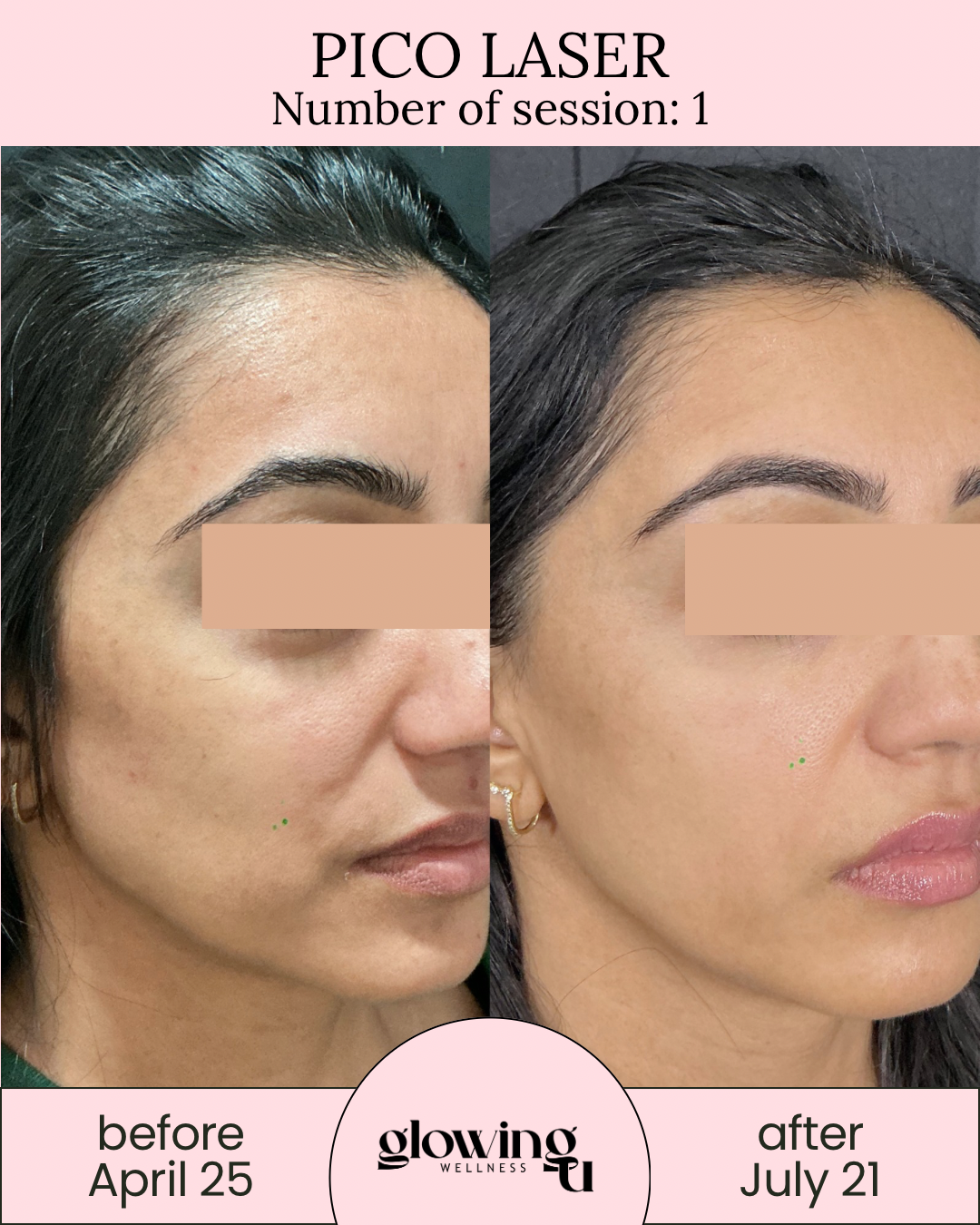 Side-by-side comparison of a woman's face before and after Pico laser treatment, with the before photo dated April 25 and the after photo dated July 21, showing reduced skin blemishes and improved skin tone.
