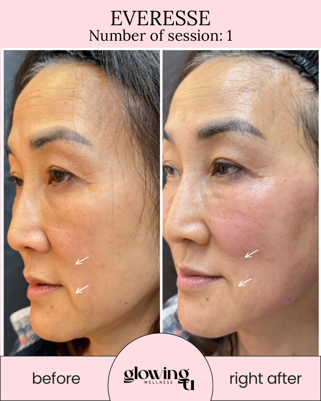 Side-by-side comparison of a woman's face showing skin before and after a EVERESSE treatment,, from Glowing U Wellness