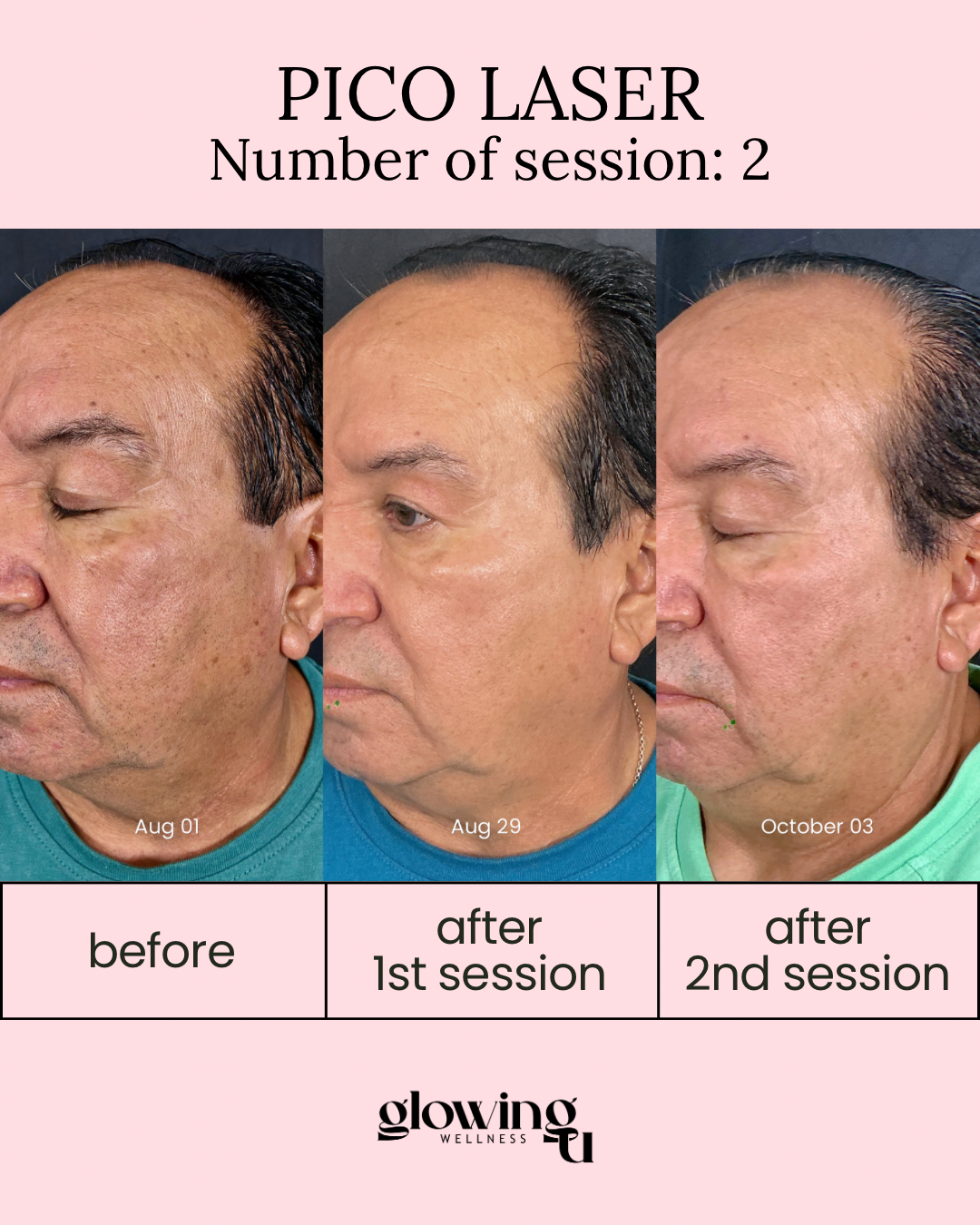 Comparison of a man's face before and after Pico Laser treatments over three months. The left photo, dated August 01, shows his face before treatment. The middle photo, dated August 29, shows his face after the first session. The right photo, dated October 03, shows his face after the second session, with noticeable improvements in skin texture and pigmentation.