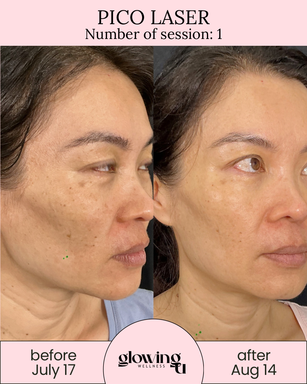 Side-by-side comparison of a woman's face showing her skin condition before and after Pico Laser treatment, with text indicating 'before July 17' and 'after August 14,' and branding for Glowing Wellness.