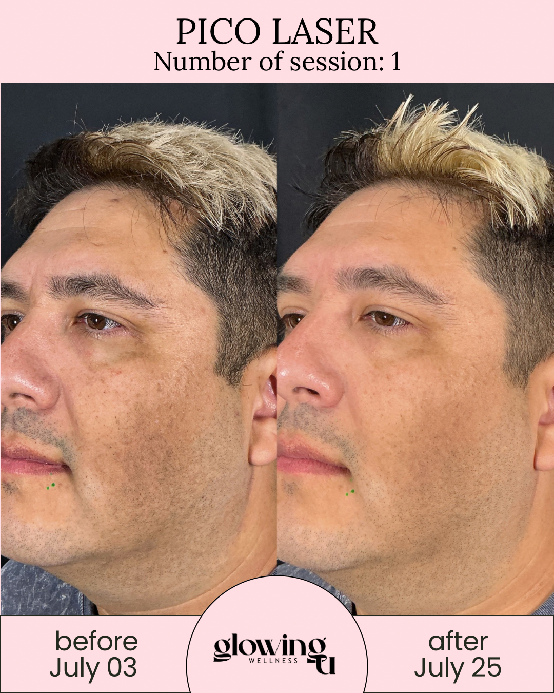 Side-by-side comparison of a man's face before and after laser treatment, showing skin improvements, with text indicating 'Pico Laser', session number 1, and dates July 3 and July 25, with branding for Glowing Wellness.