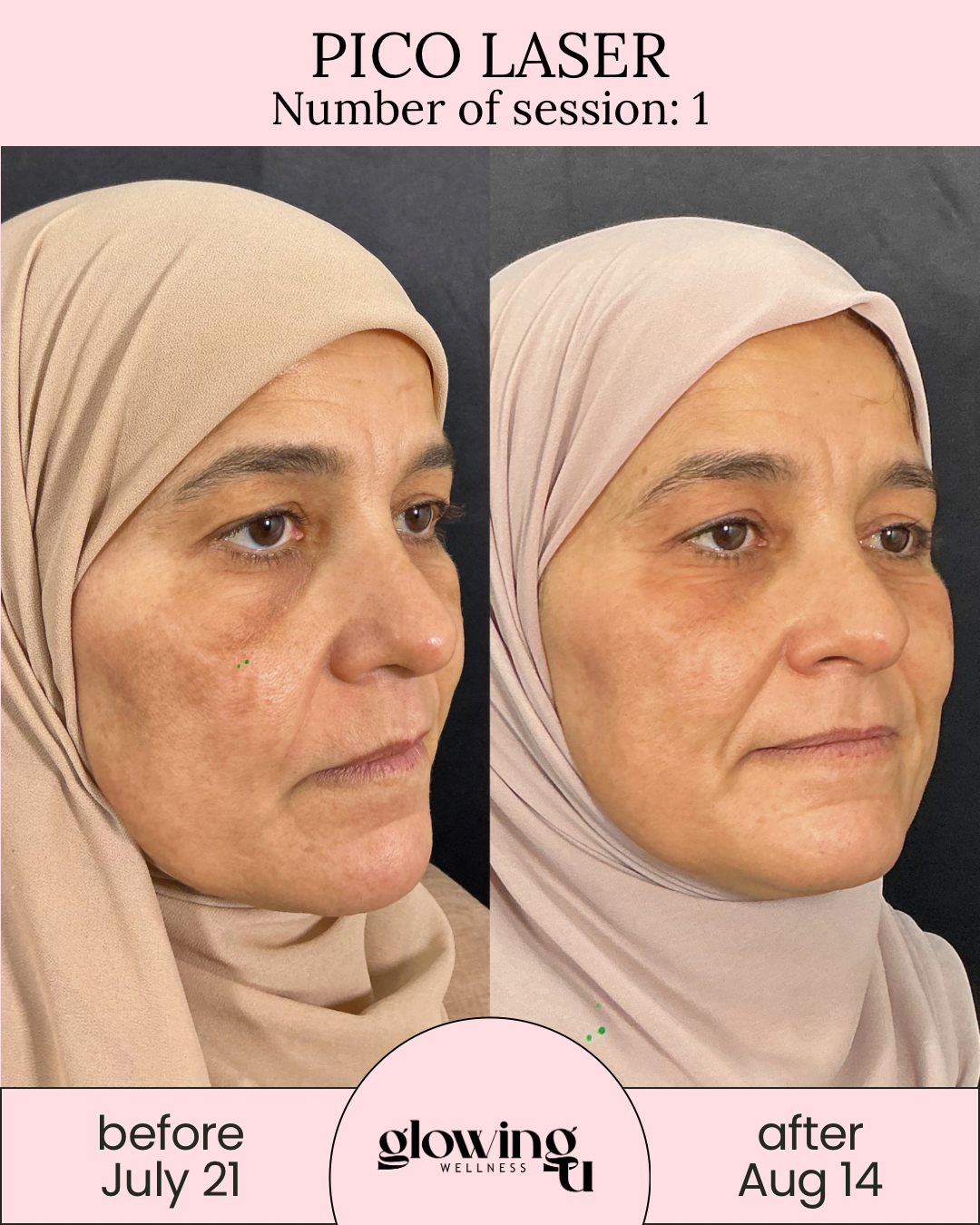 Side-by-side comparison of a woman's face before and after a Pico Laser treatment. The left image shows her face on July 21 with uneven skin tone and dark spots. The right image shows her face on August 14 with improved skin texture and reduced discoloration. Each photo features a beige hijab, with the background being dark. The top section mentions "Pico Laser" and "Number of session: 1." The bottom section displays the clinic's logo, "glowing WELLNESS," and the respective dates of the images.