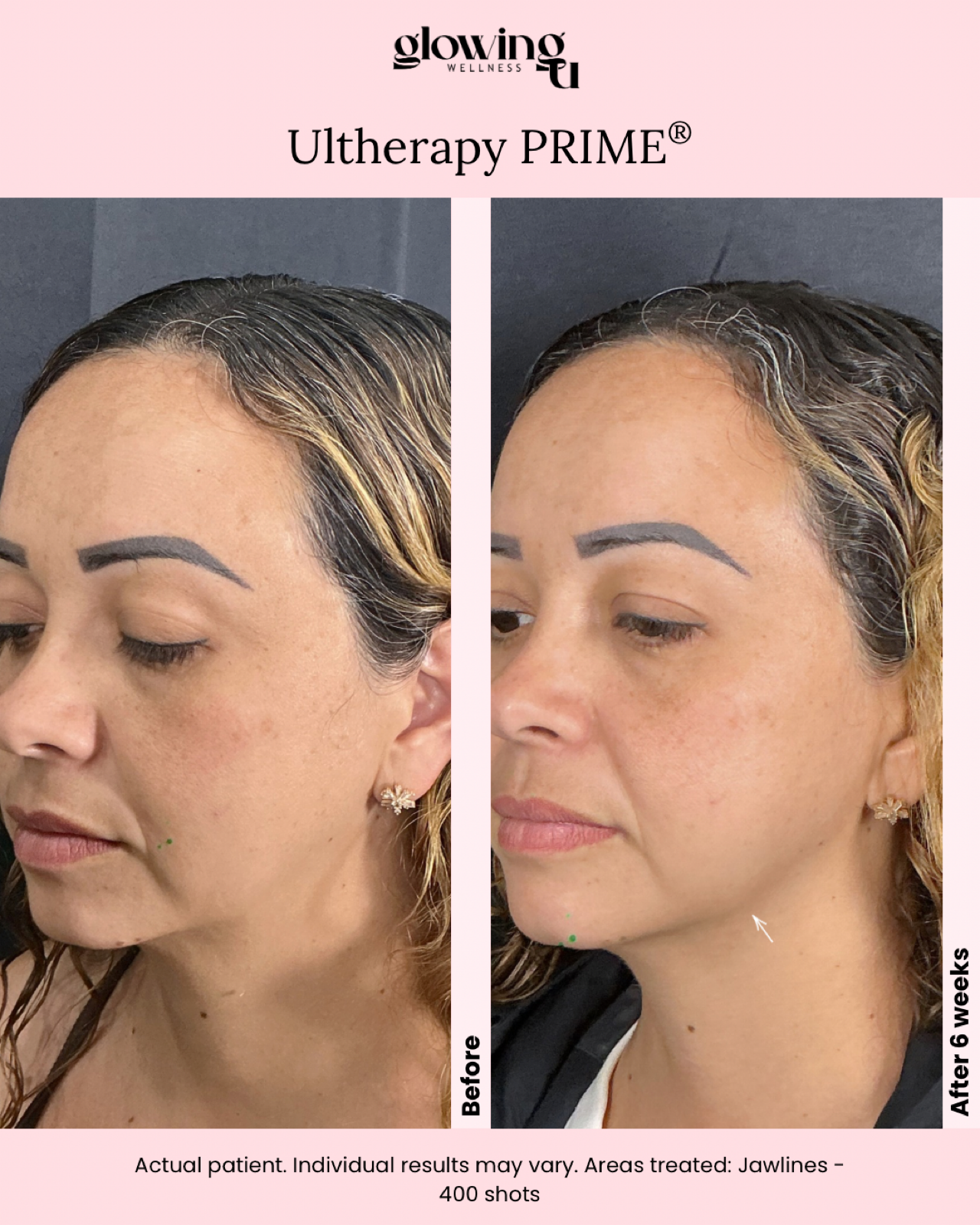 Side-by-side comparison of a woman’s face before and after six weeks of Ultherapy Prime treatment. The "before" image shows skin with more visible signs of aging, while the "after" image shows smoother, tighter skin, especially around the jawline and cheeks.