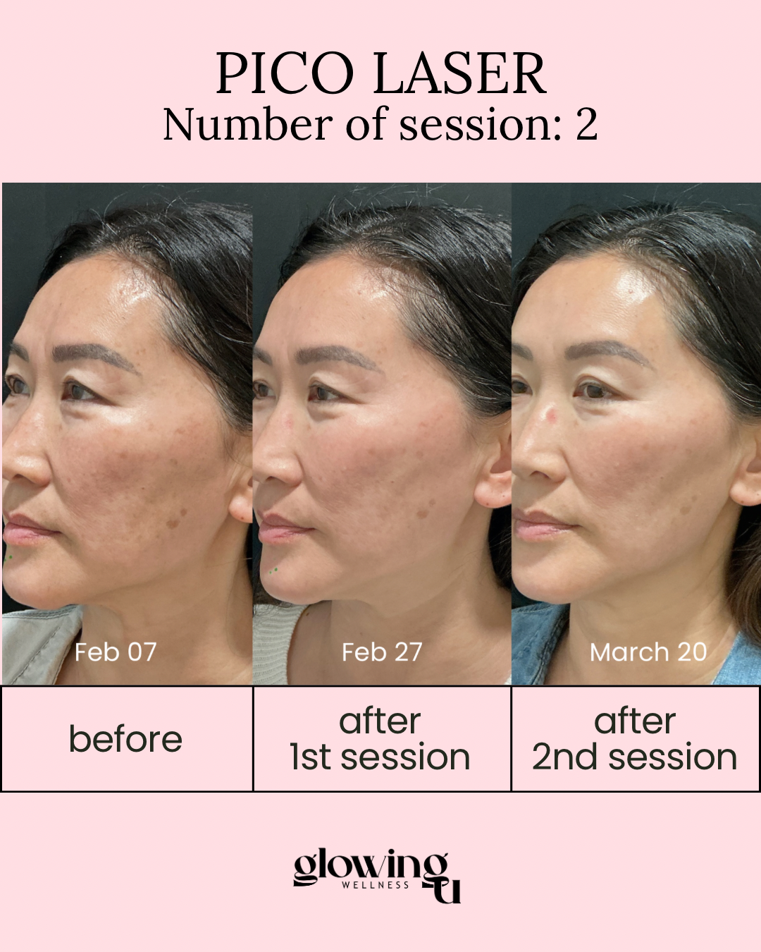 Progress photos of a woman showing skin improvement over time after Pico Laser treatments. The images are labeled with dates: February 07, February 27, and March 20, with captions indicating "before," "after 1st session," and "after 2nd session." The background is pink with black text and the logo "glowing wellness" at the bottom.