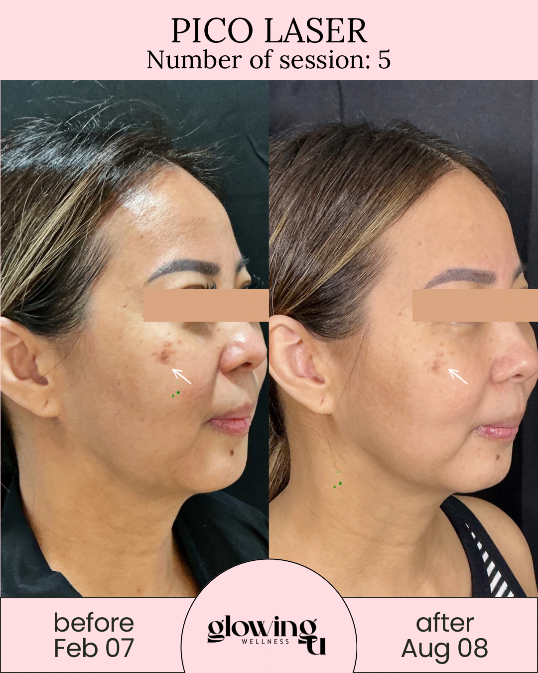 Side-by-side comparison of a woman’s face before and after Pico Laser treatment, showing improved skin texture and reduced pigmentation. The before photo is dated February 7, and the after photo is August 8, with text indicating a total of 5 sessions from Glowing Wellness.