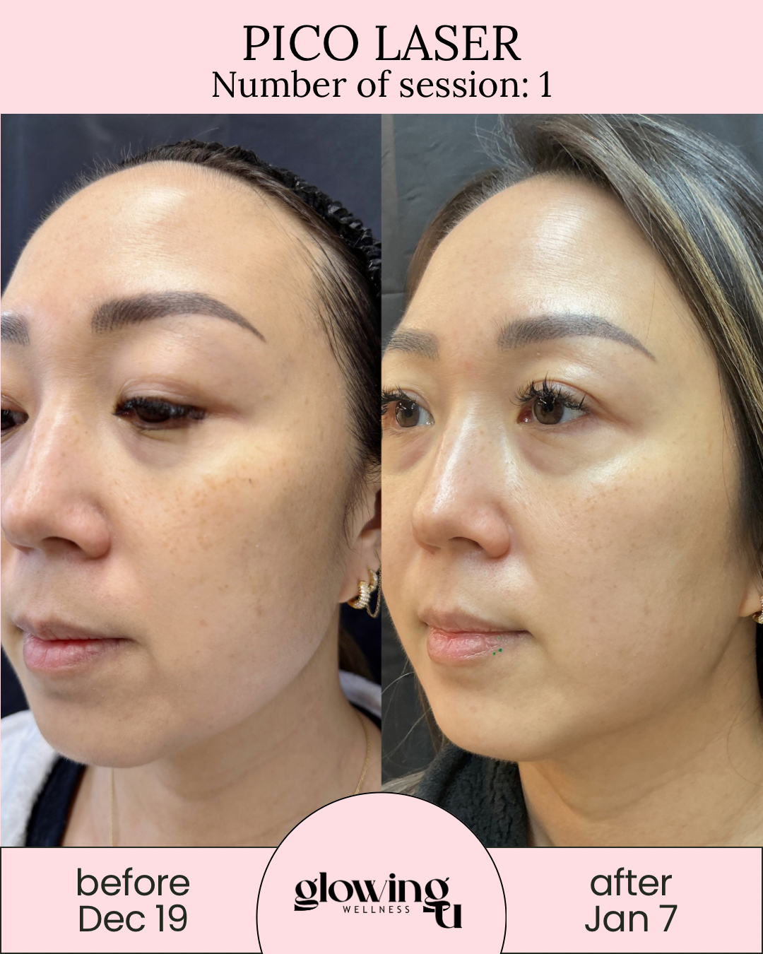 Side-by-side comparison showing a woman's face before and after Pico Laser treatment. The left image is labeled "before Dec 19," and the right image is labeled "after Jan 7," highlighting improvements in skin texture and pigmentation.