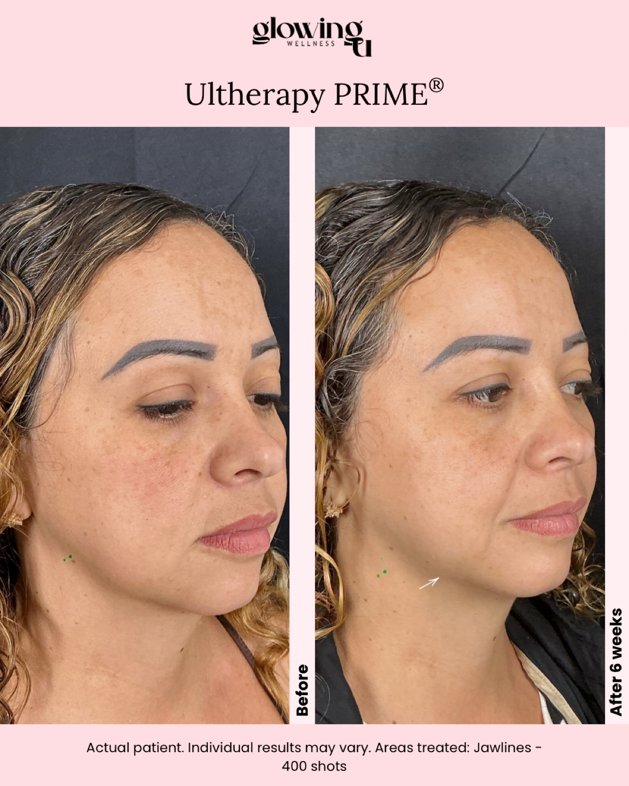Side-by-side comparison of a woman's face showing the results of Ultherapy treatment. The left image, labeled 'Before,' shows the woman's skin with some sagging and loose areas. The right image, labeled 'After 6 weeks,' shows the skin more lifted and firmed, with improved facial contour and reduced sagging.