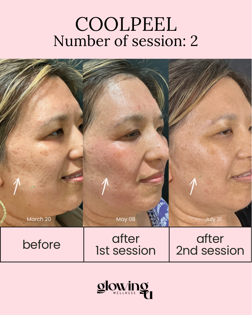 A sequence of three side-profile photos showing a woman's facial skin improvements over time, labeled with dates March 20, May 8, and July 31, for a skincare treatment called COOLPEEL, with the number of sessions listed as 2. The background is pink with branding for Glowing Wellness.