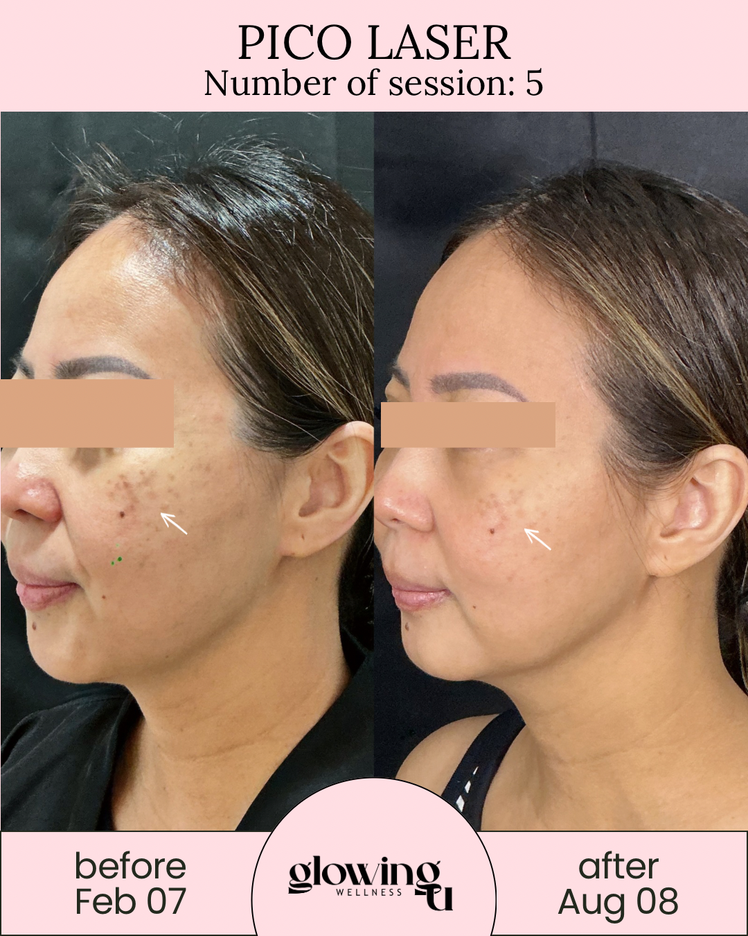 Side-by-side comparison of a woman's face before and after Pico Laser treatment. The left side shows her skin before the treatment, with dark spots and uneven tone, dated February 7. The right side shows her skin after the treatment, with reduced dark spots, dated August 8. Both images highlight skin improvements in pigmentation.
